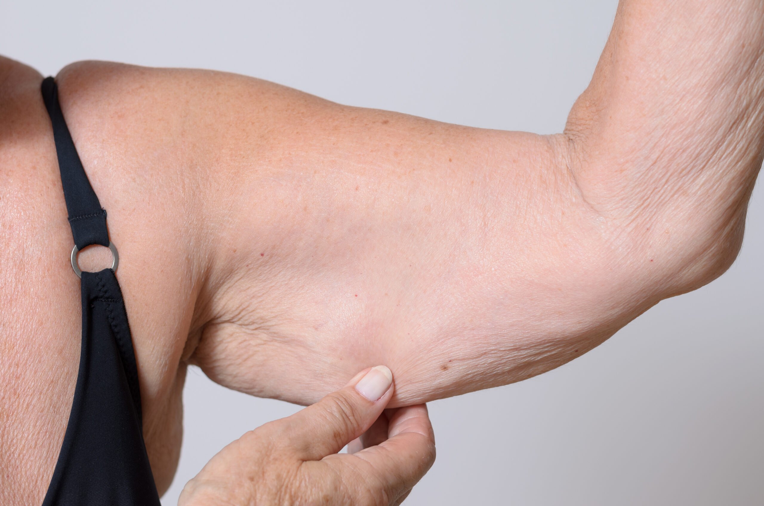 Expert Arm Lift Surgery to Transform Your Confidence