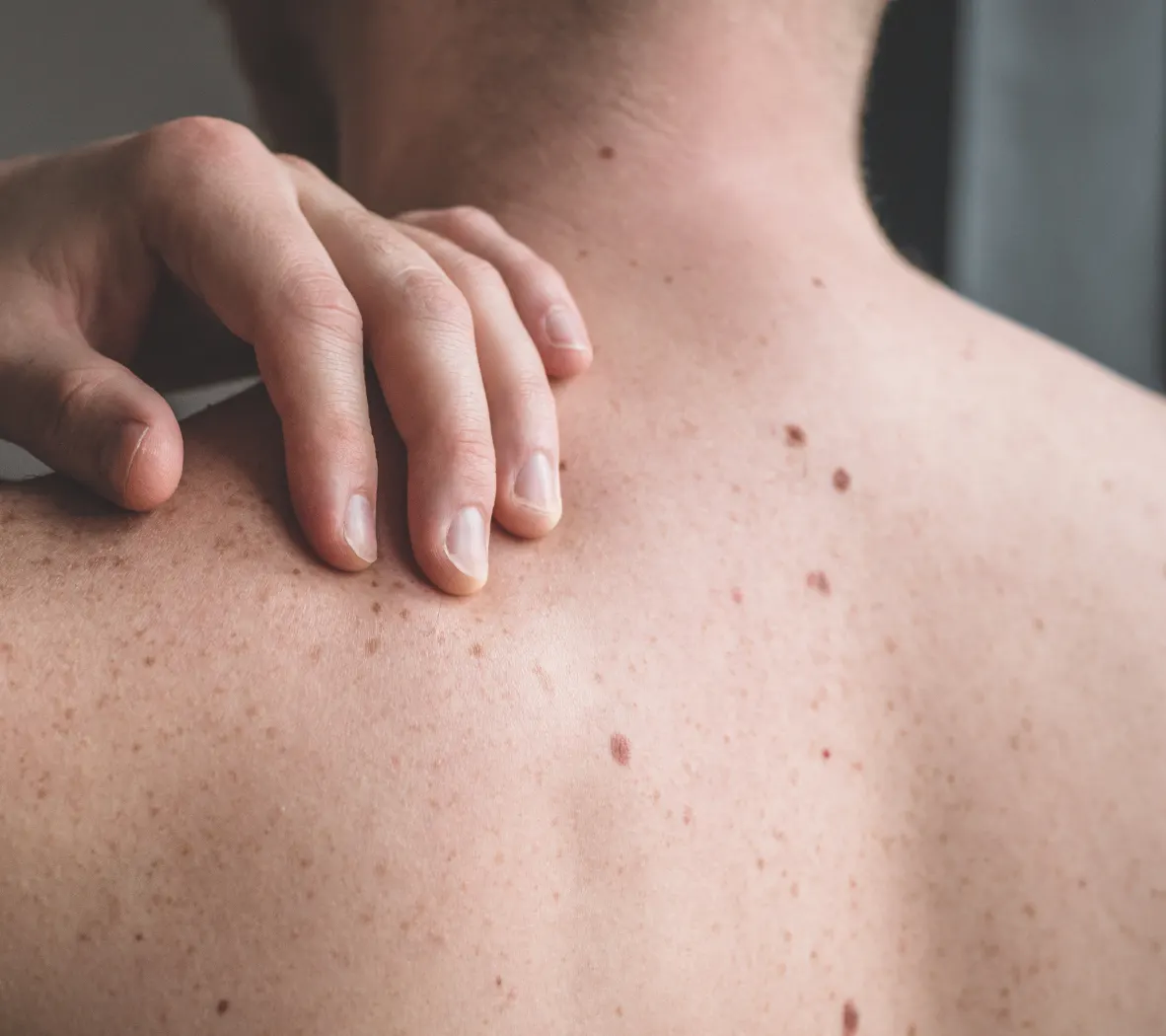 Skin surgery