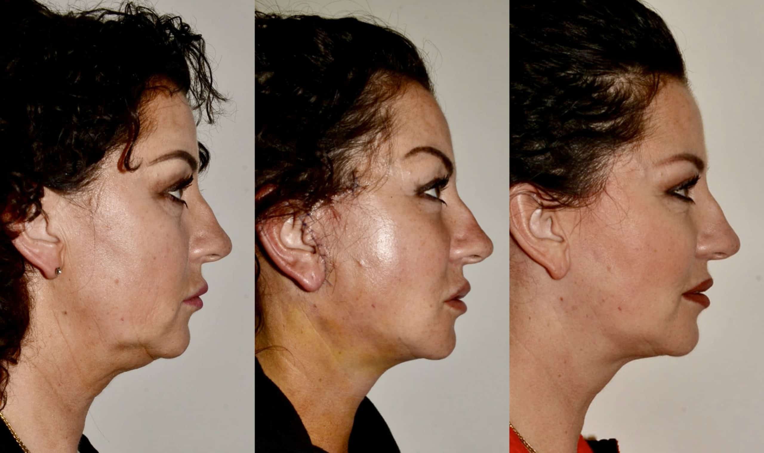 lower face neck lift