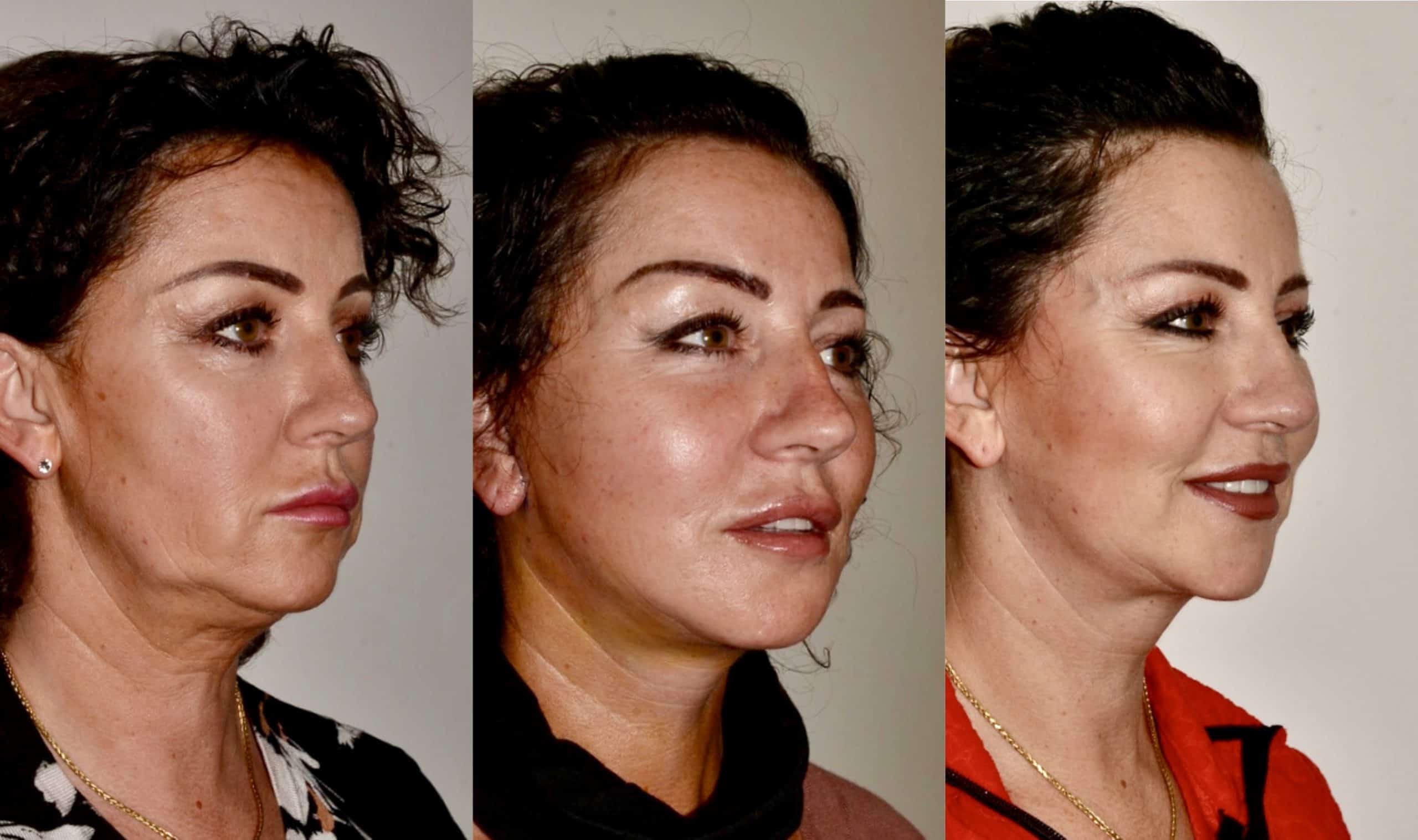 lower face neck lift