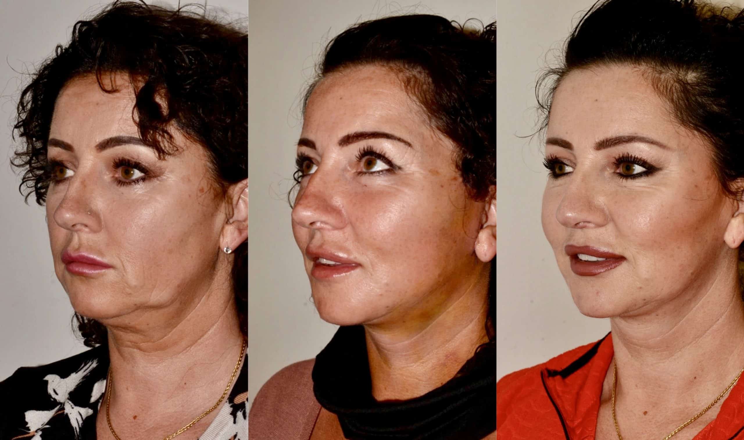 lower face neck lift