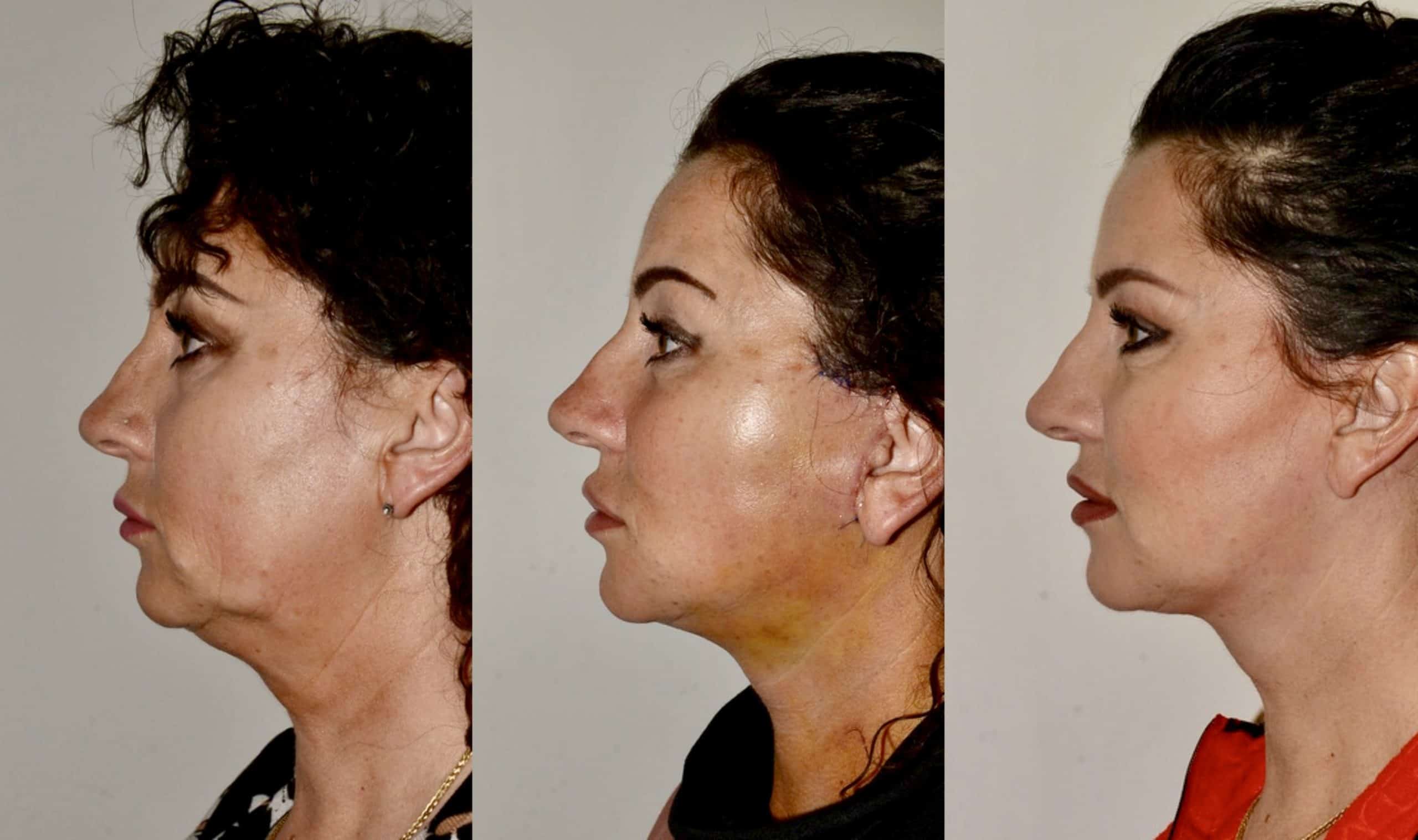 lower face neck lift