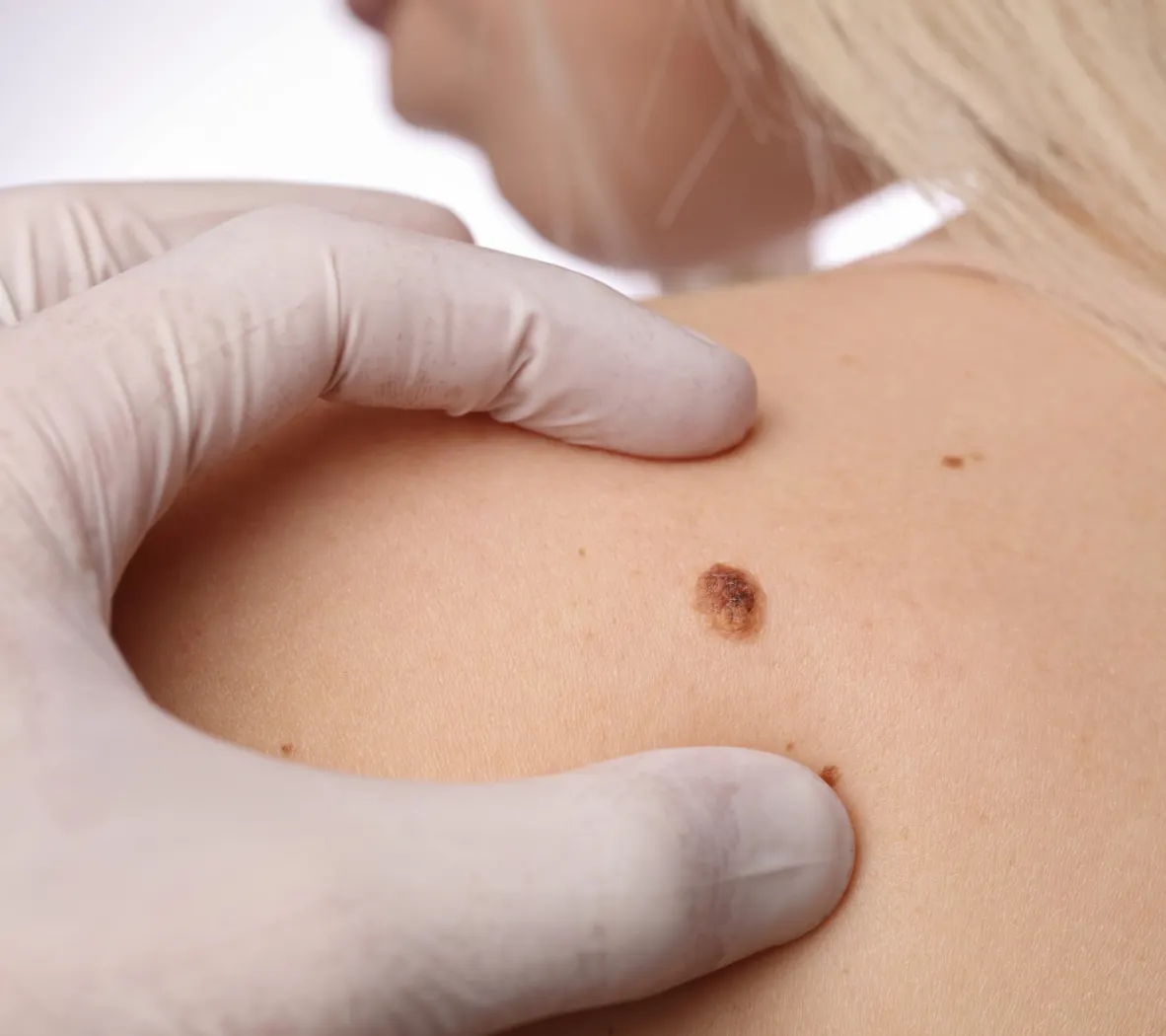 private skin surgery benign skin lesions