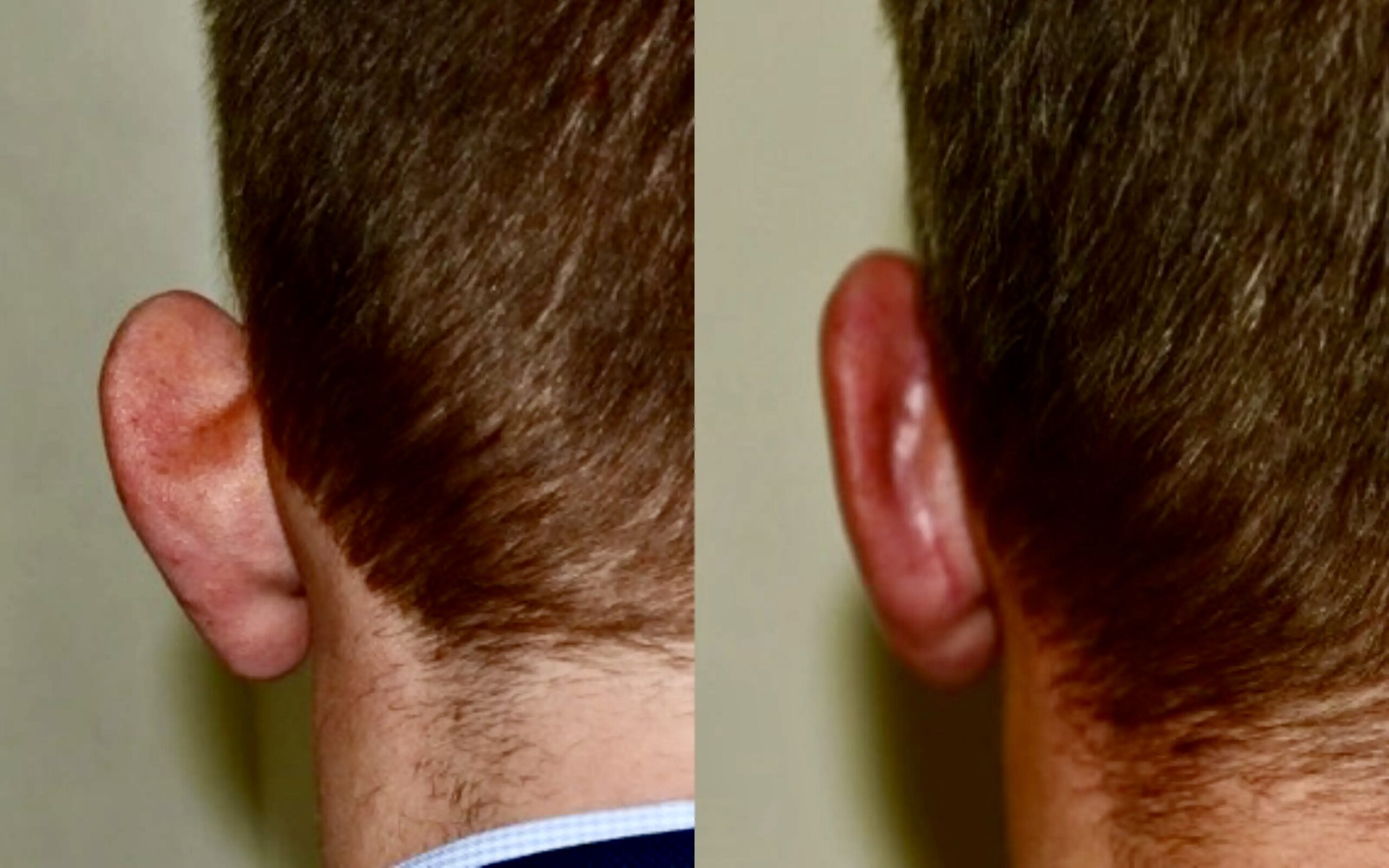 before and after ear correction