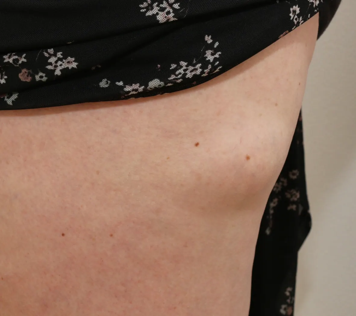 lipoma removal edinburgh