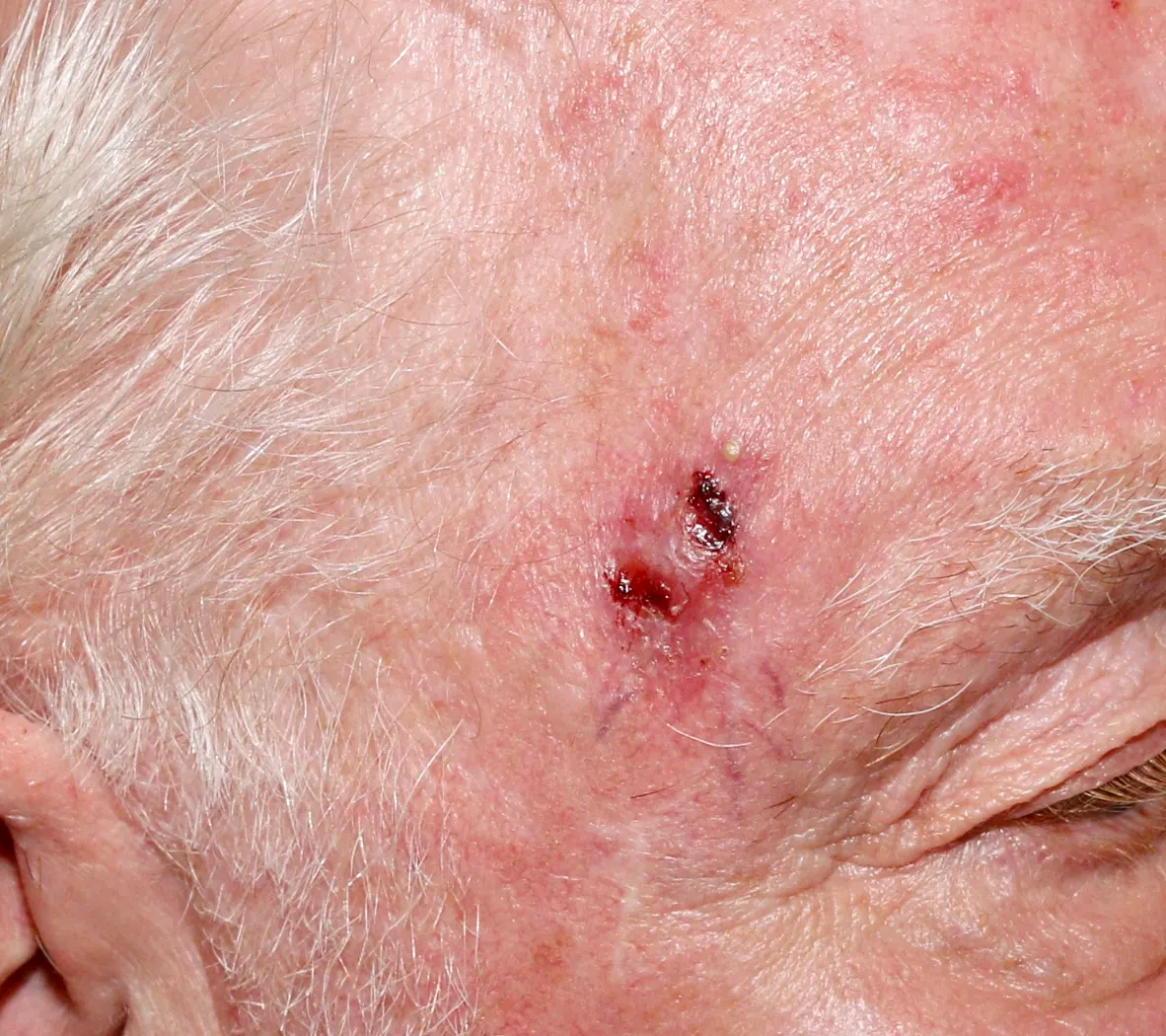 private skin cancer treatment edinburgh