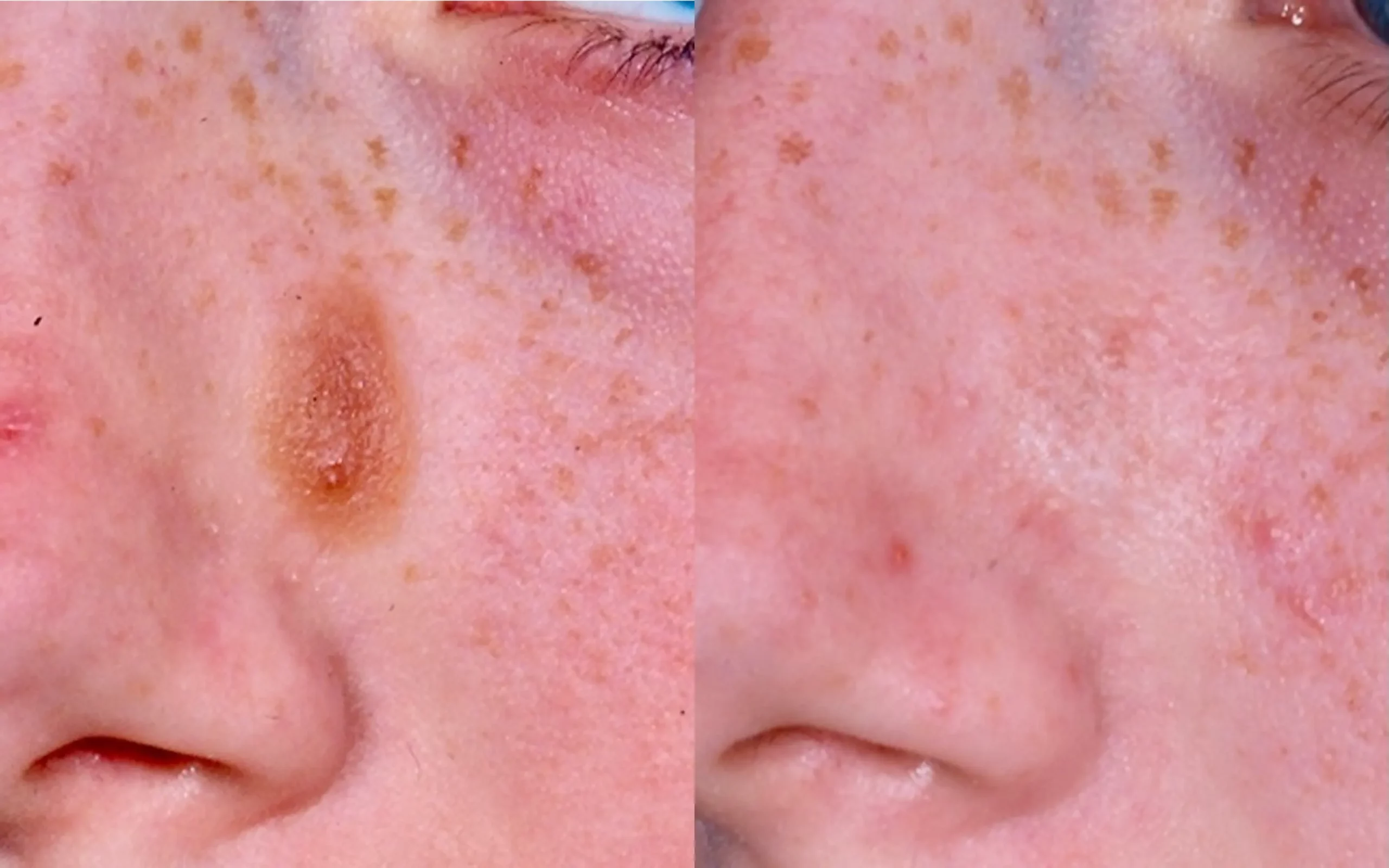 Cheek keratosis - laser shave