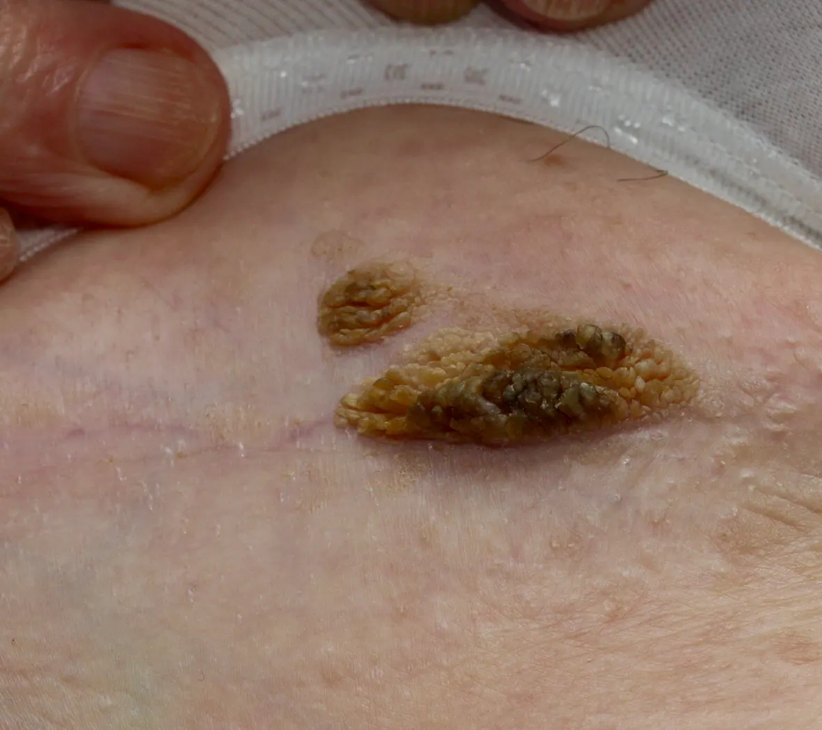 large keratosis trunk