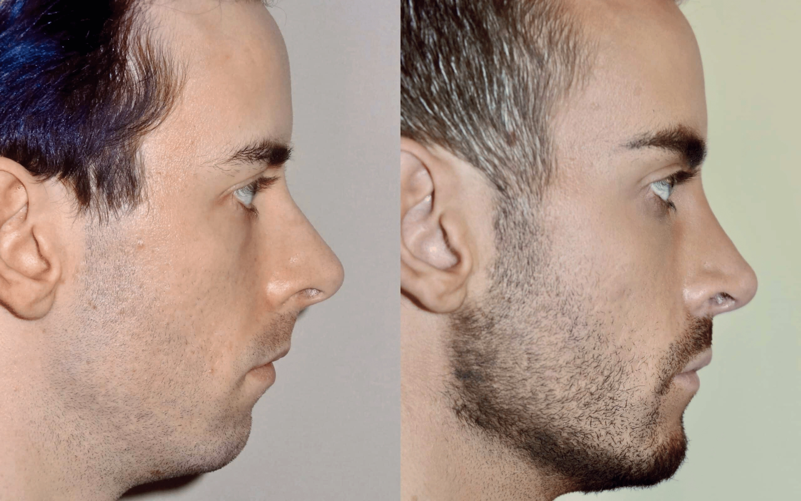 chin implant