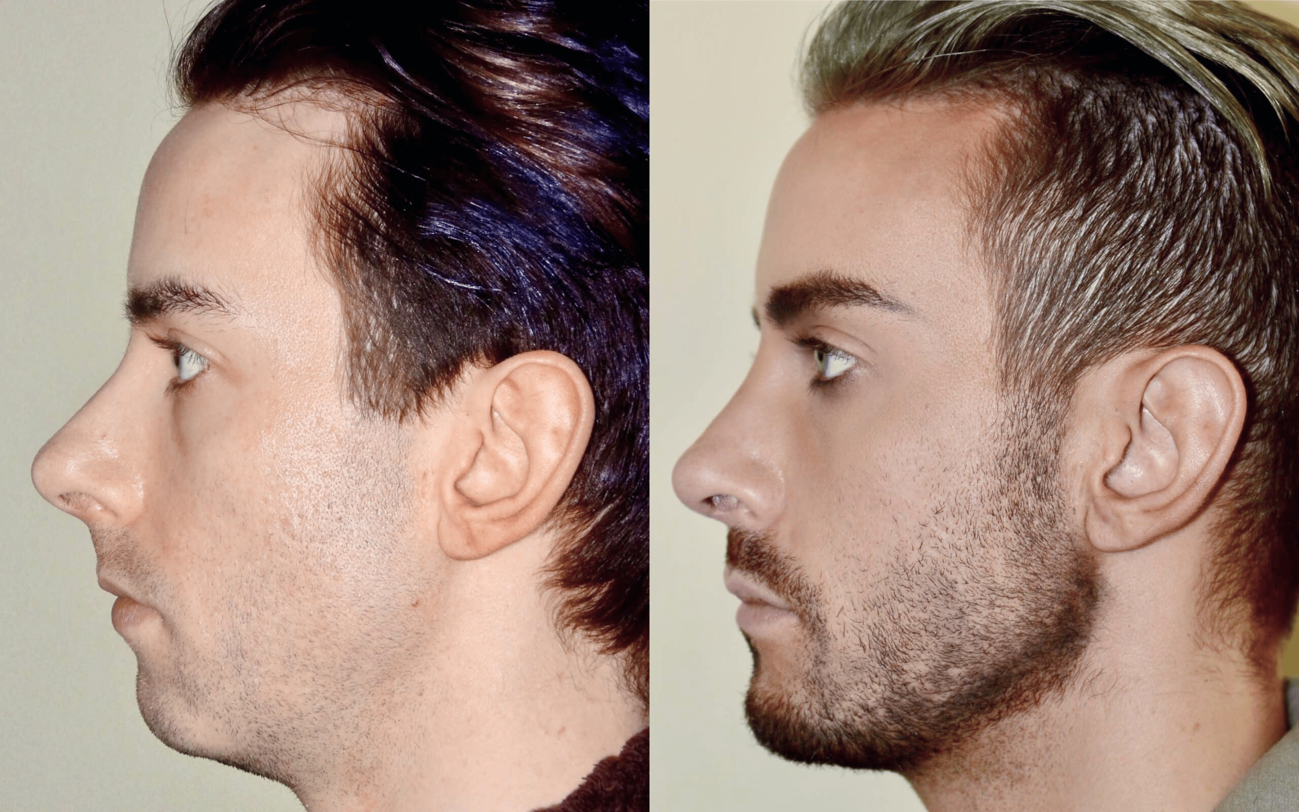chin implant
