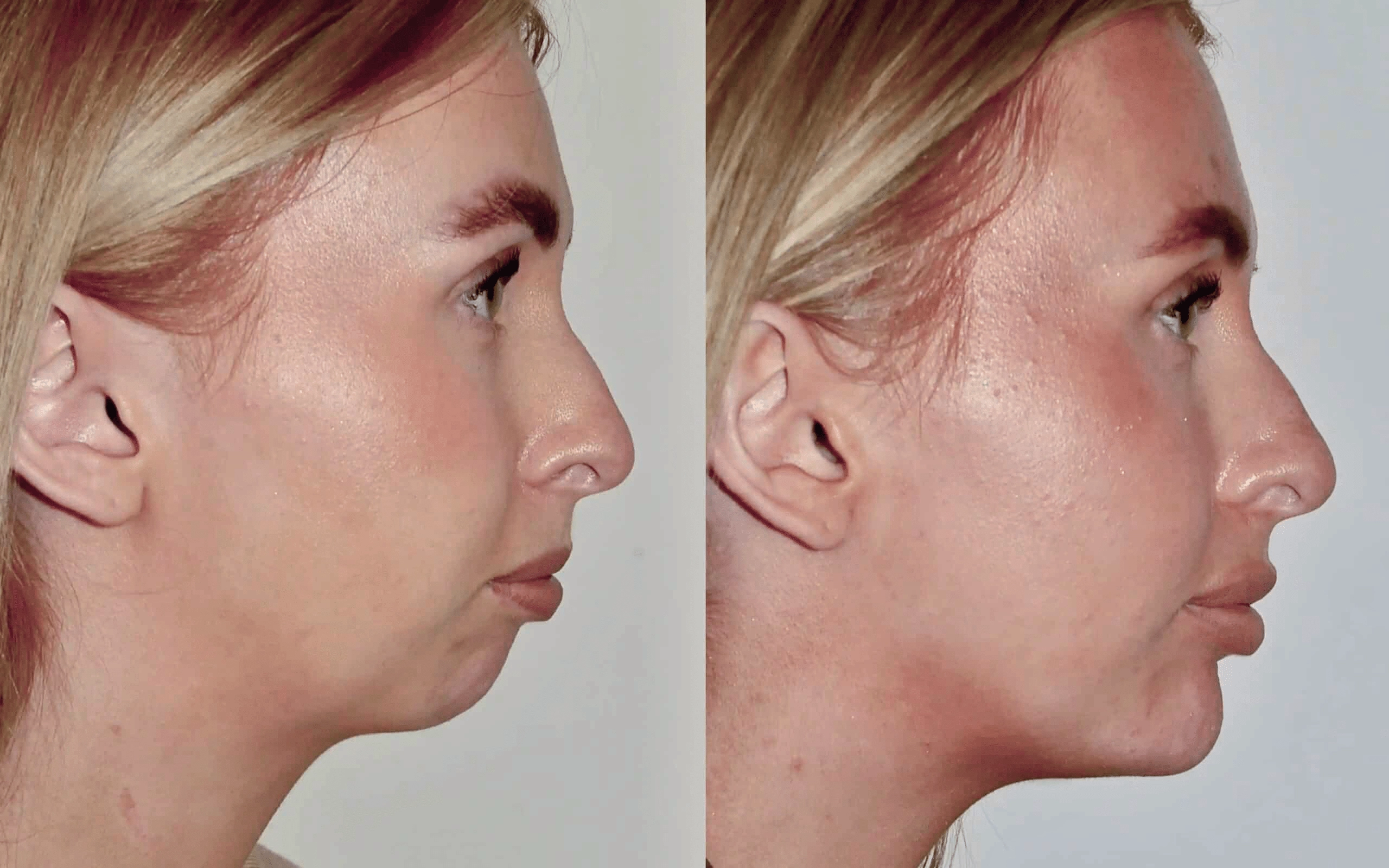 chin implant
