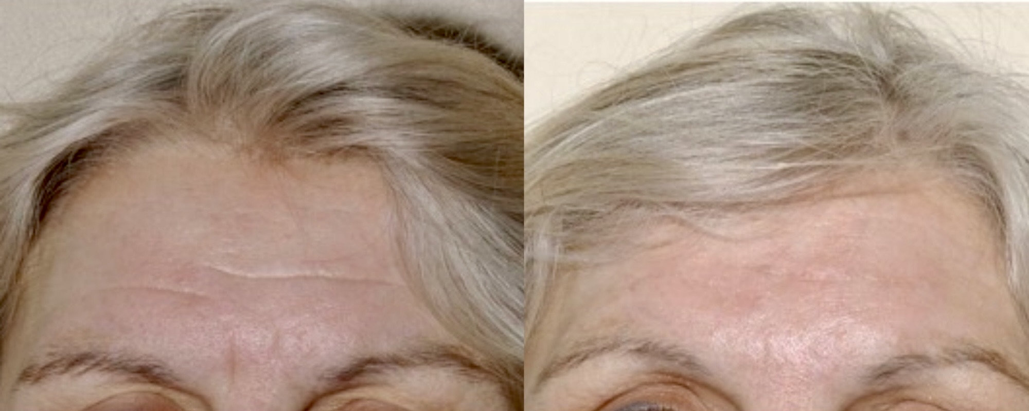 fillers for forehead creases