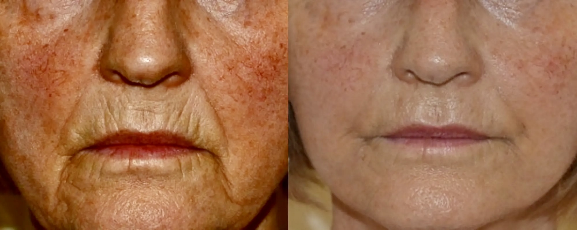 upper lip lines and nasolabial folds