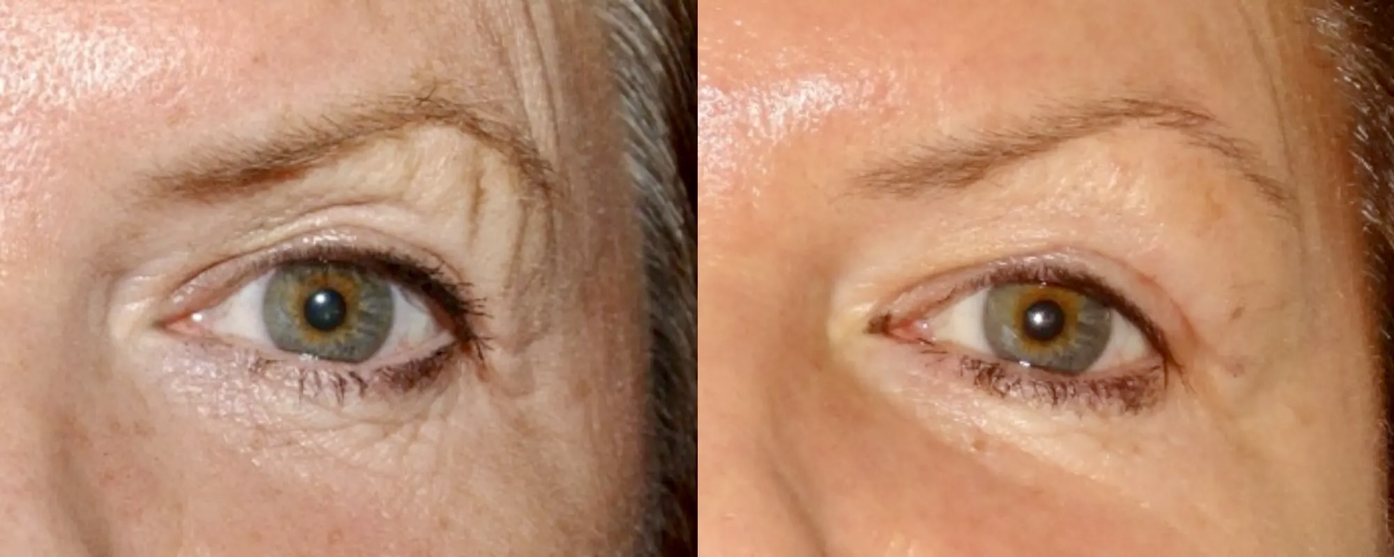non surgical brow lift