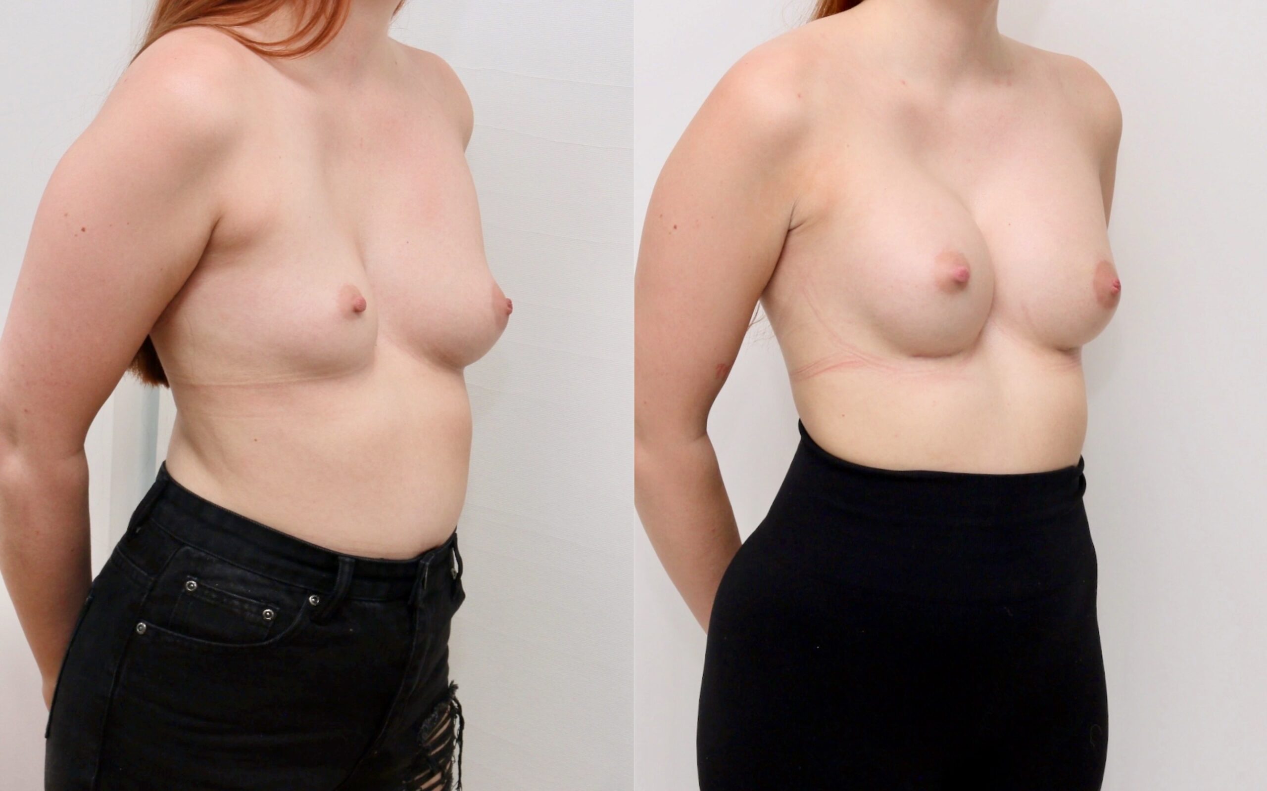 breast asymmetry correction scotland
