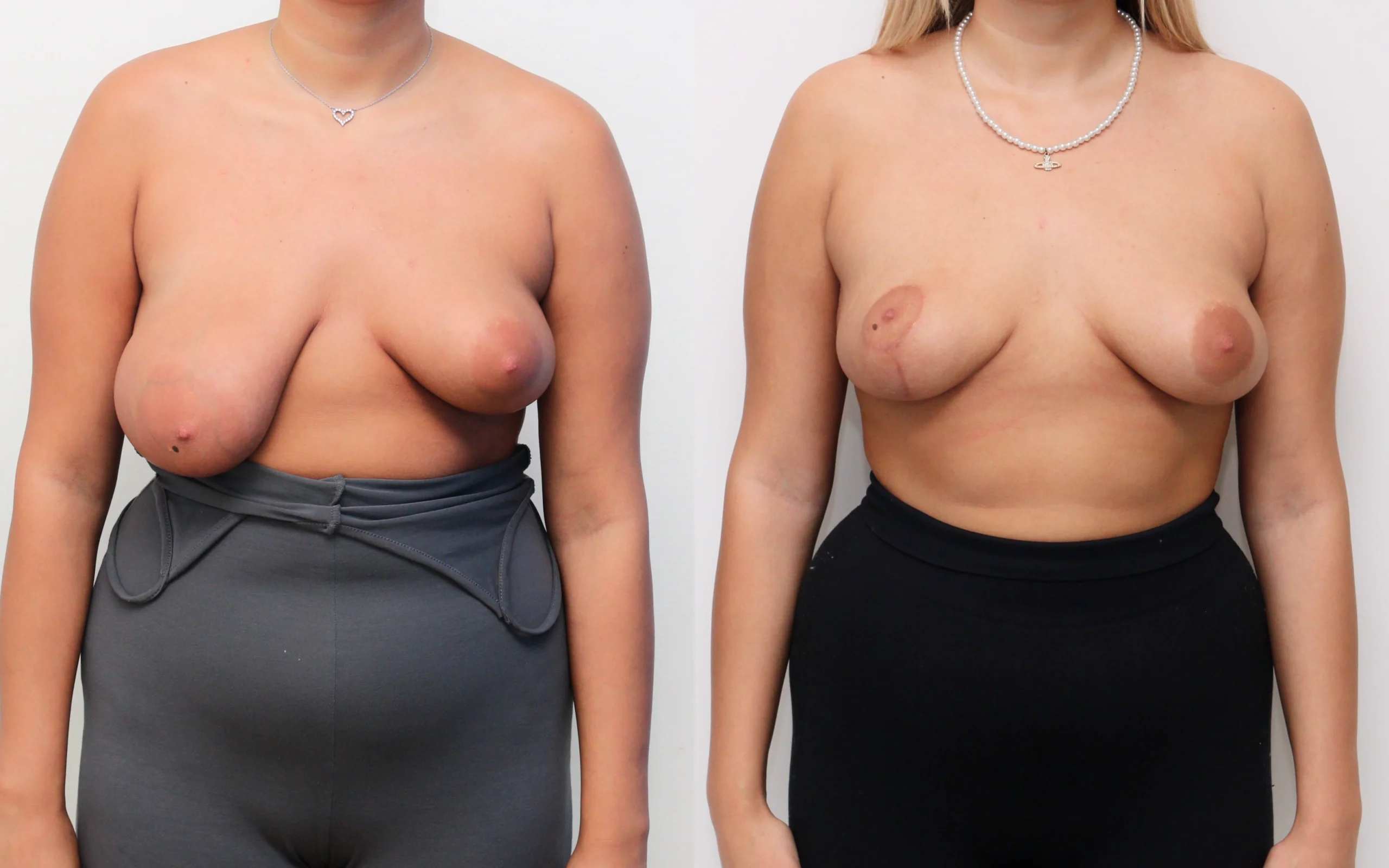 breast asymmetry correction