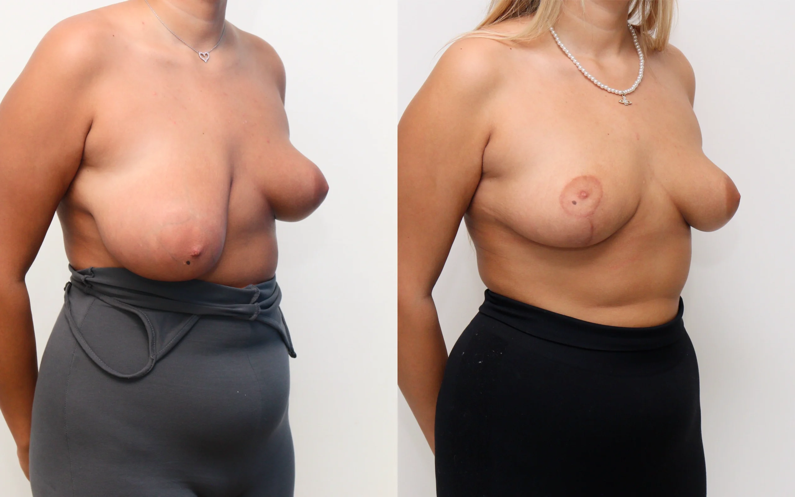breast asymmetry correction
