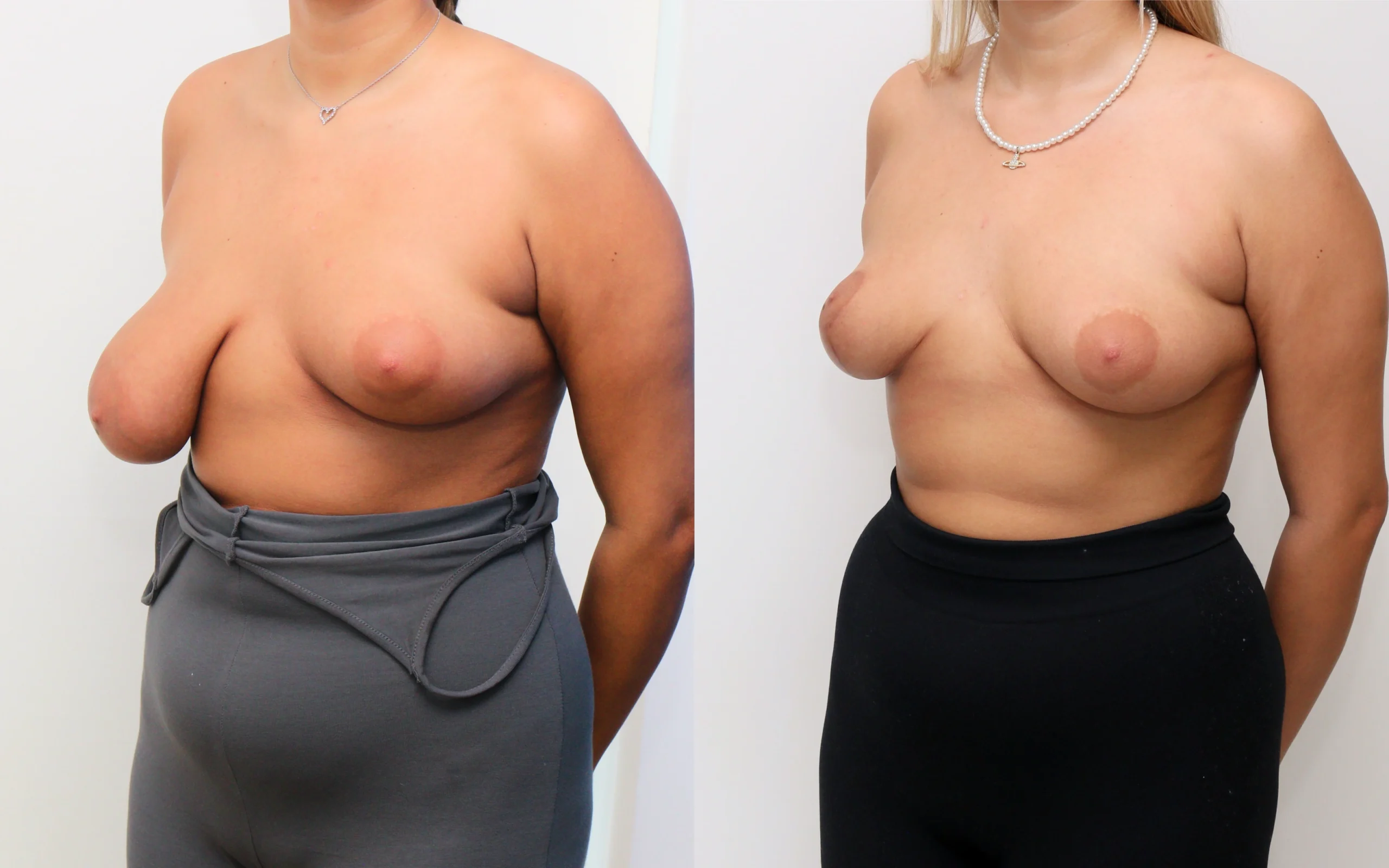 breast asymmetry correction