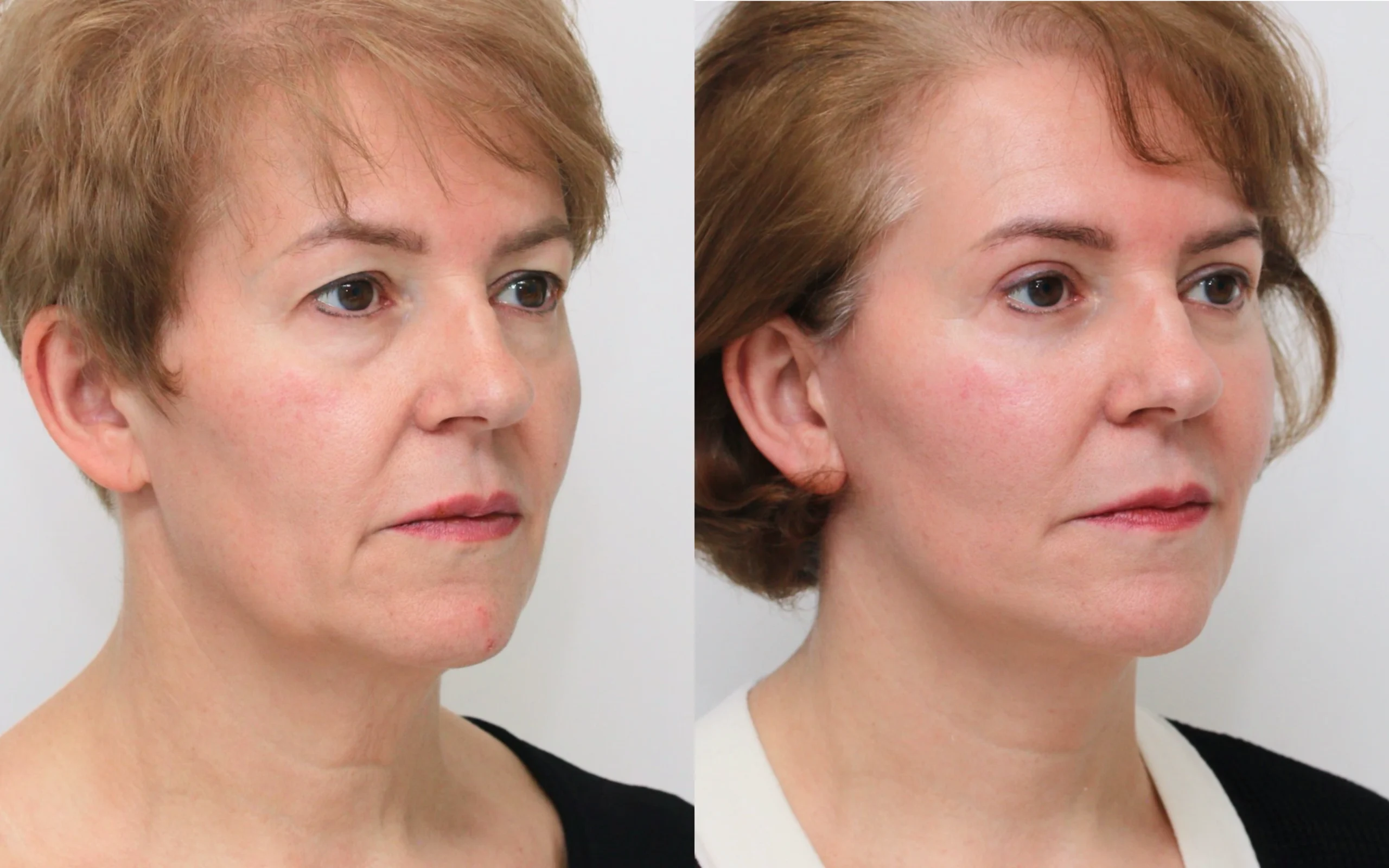 lower face neck lift
