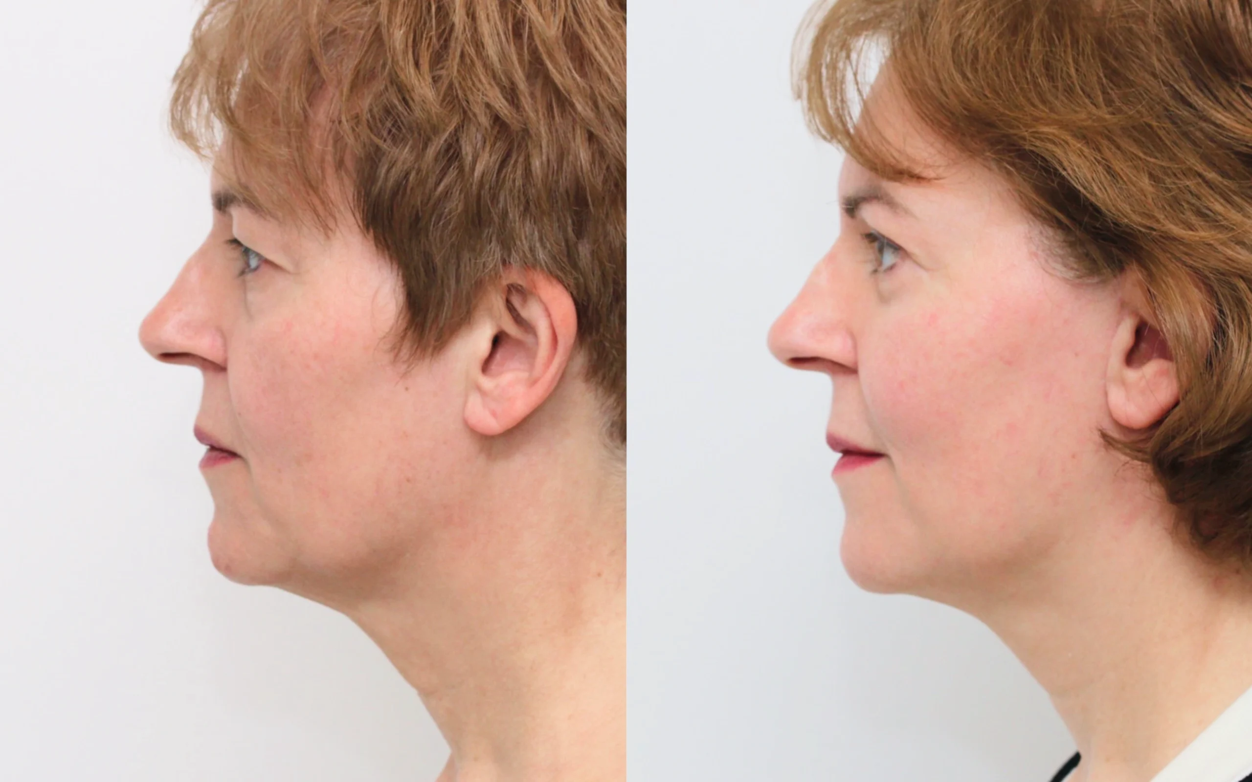 lower face neck lift