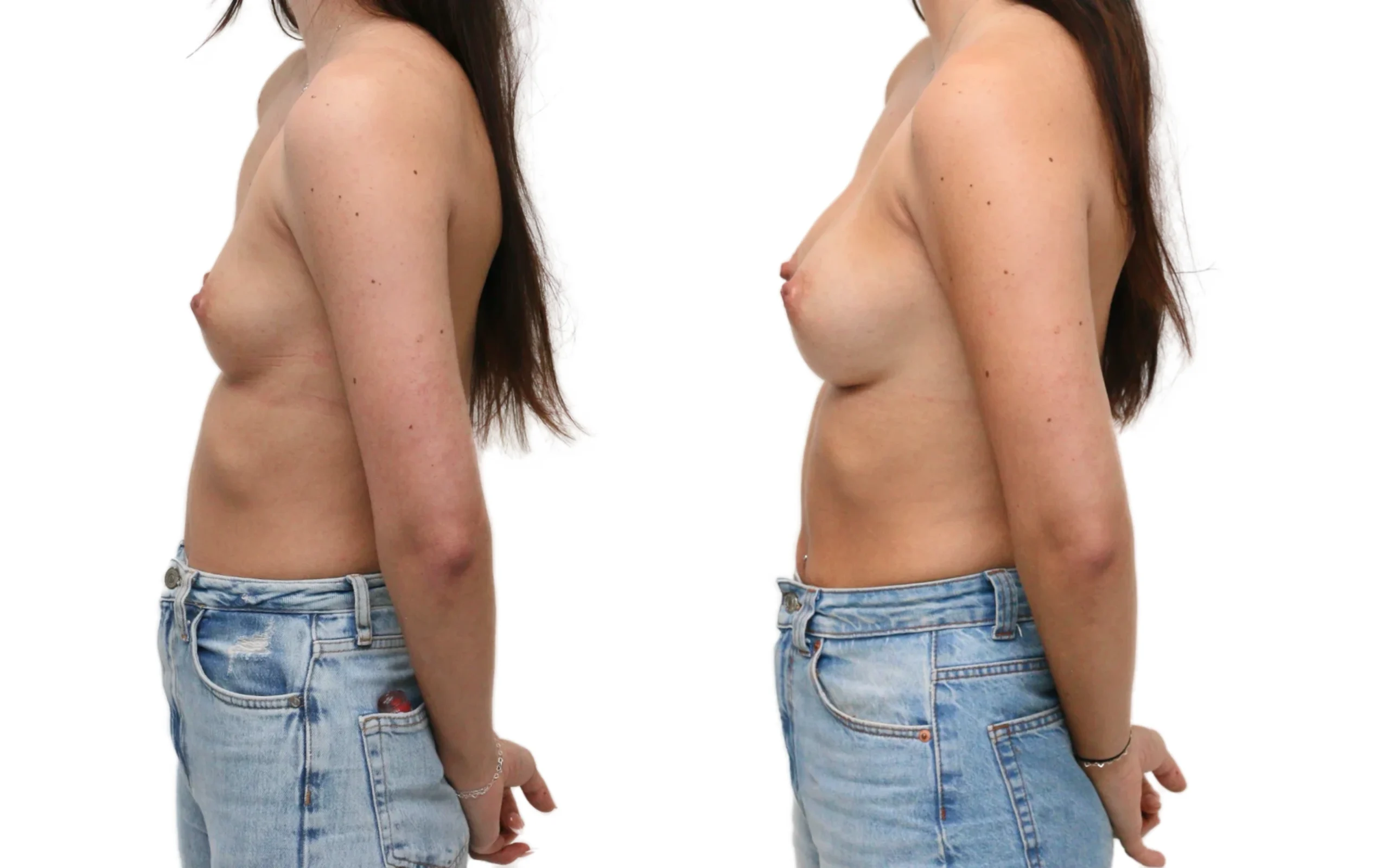 Breast Asymmetry