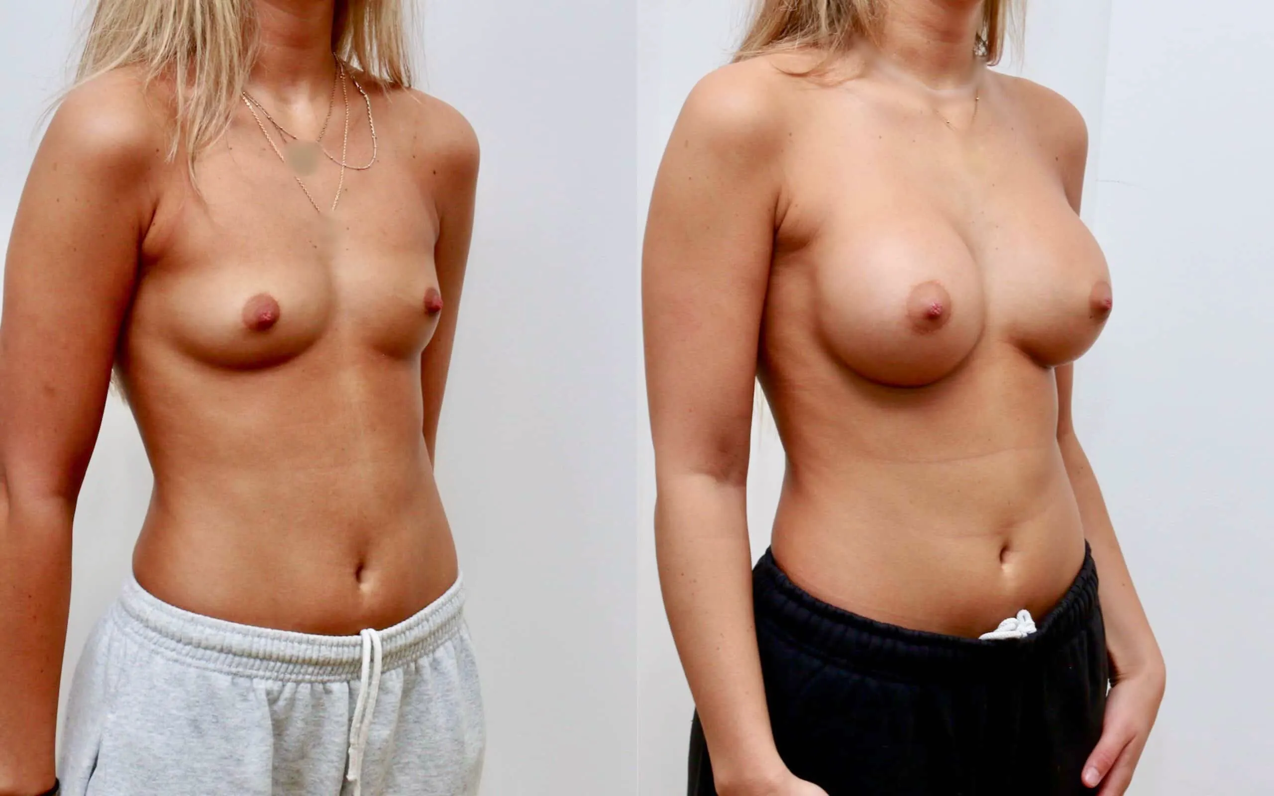 breast implants scotland