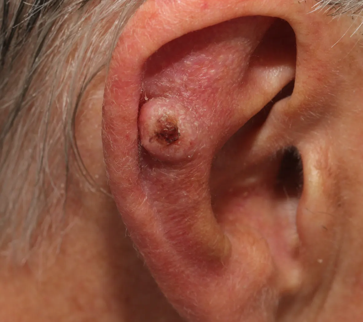 SCC removal edinburgh squamous cell carcinoma