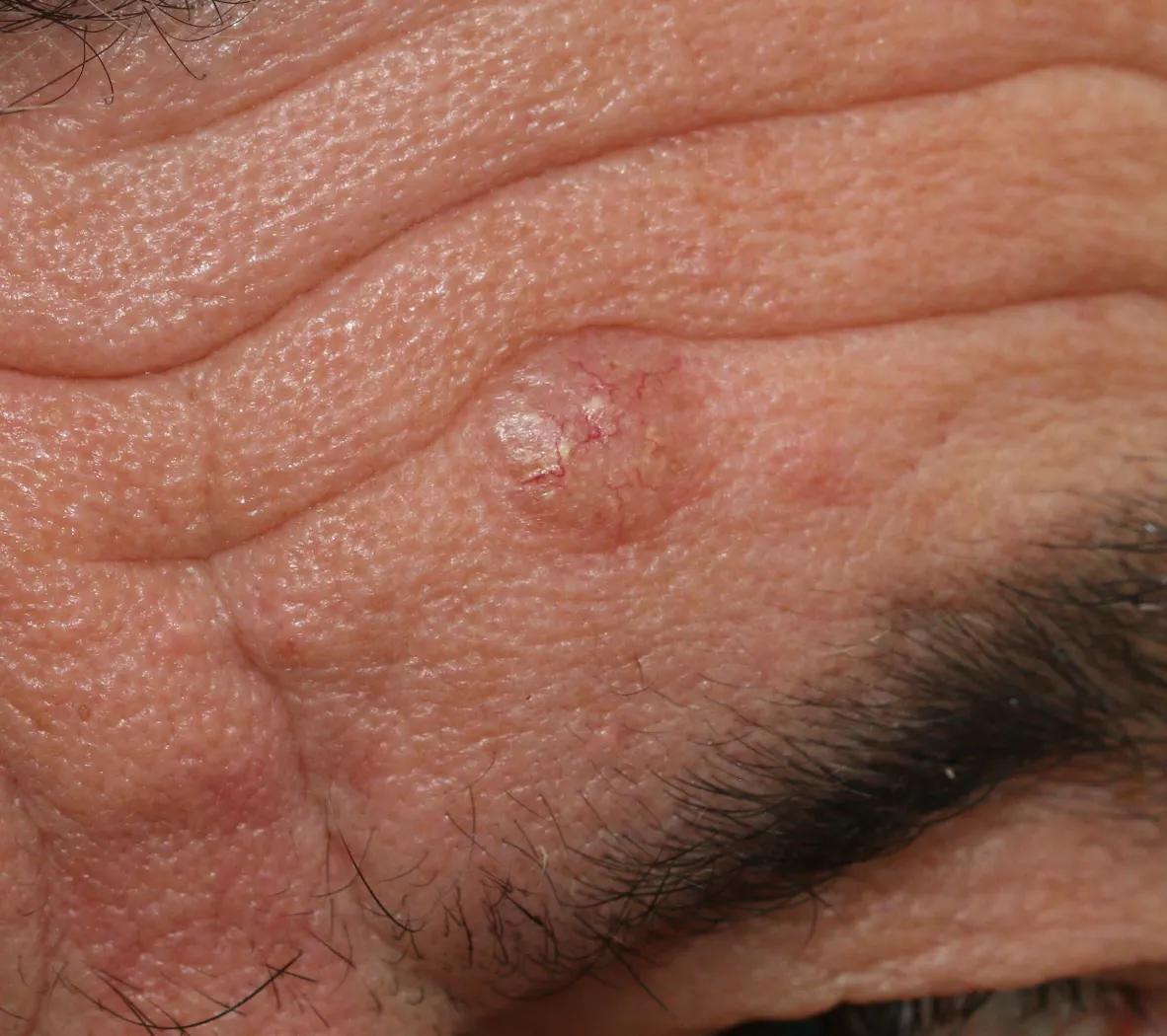 basal cell carcinoma removal edinburgh