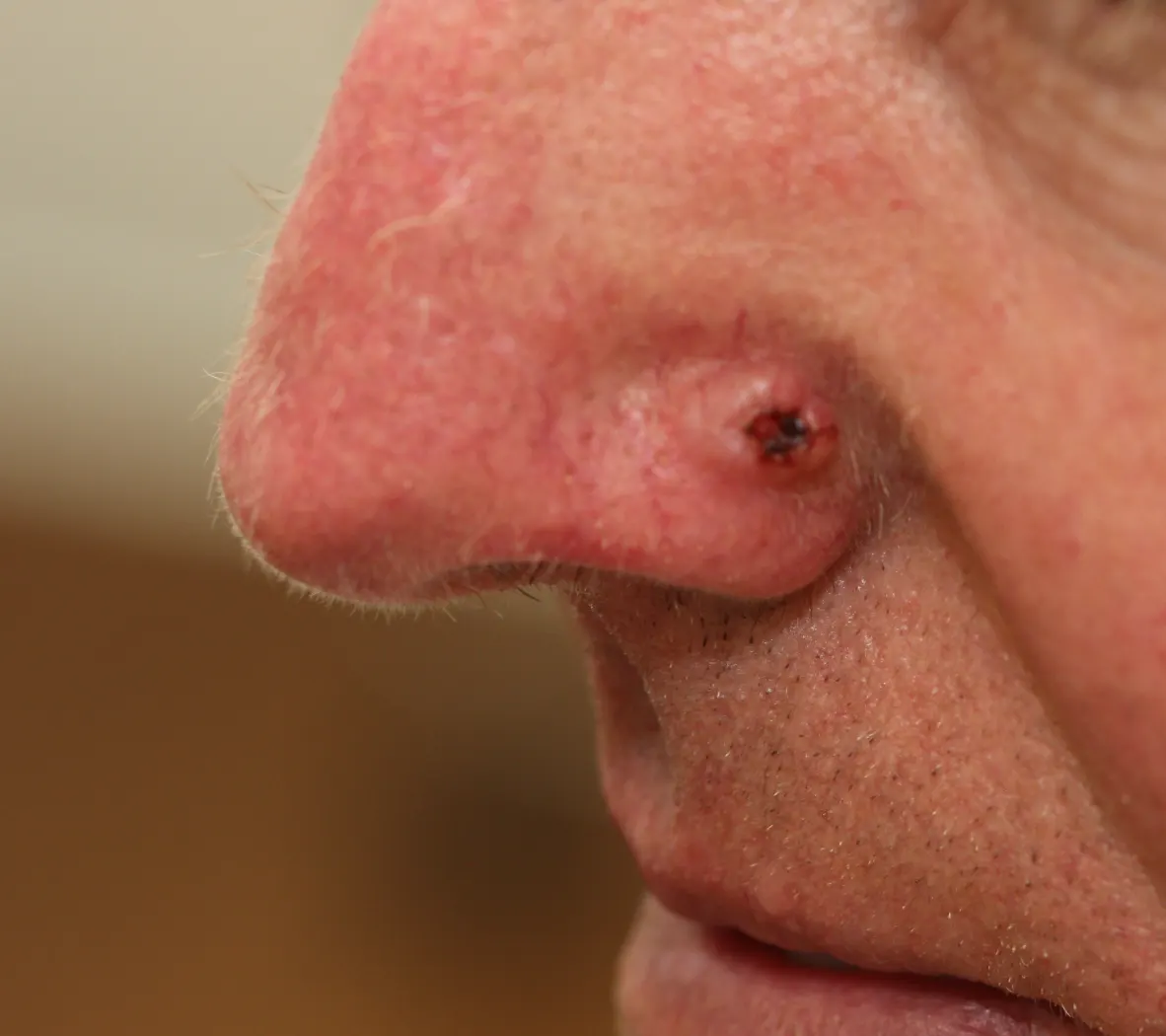 basal cell carcinoma removal edinburgh