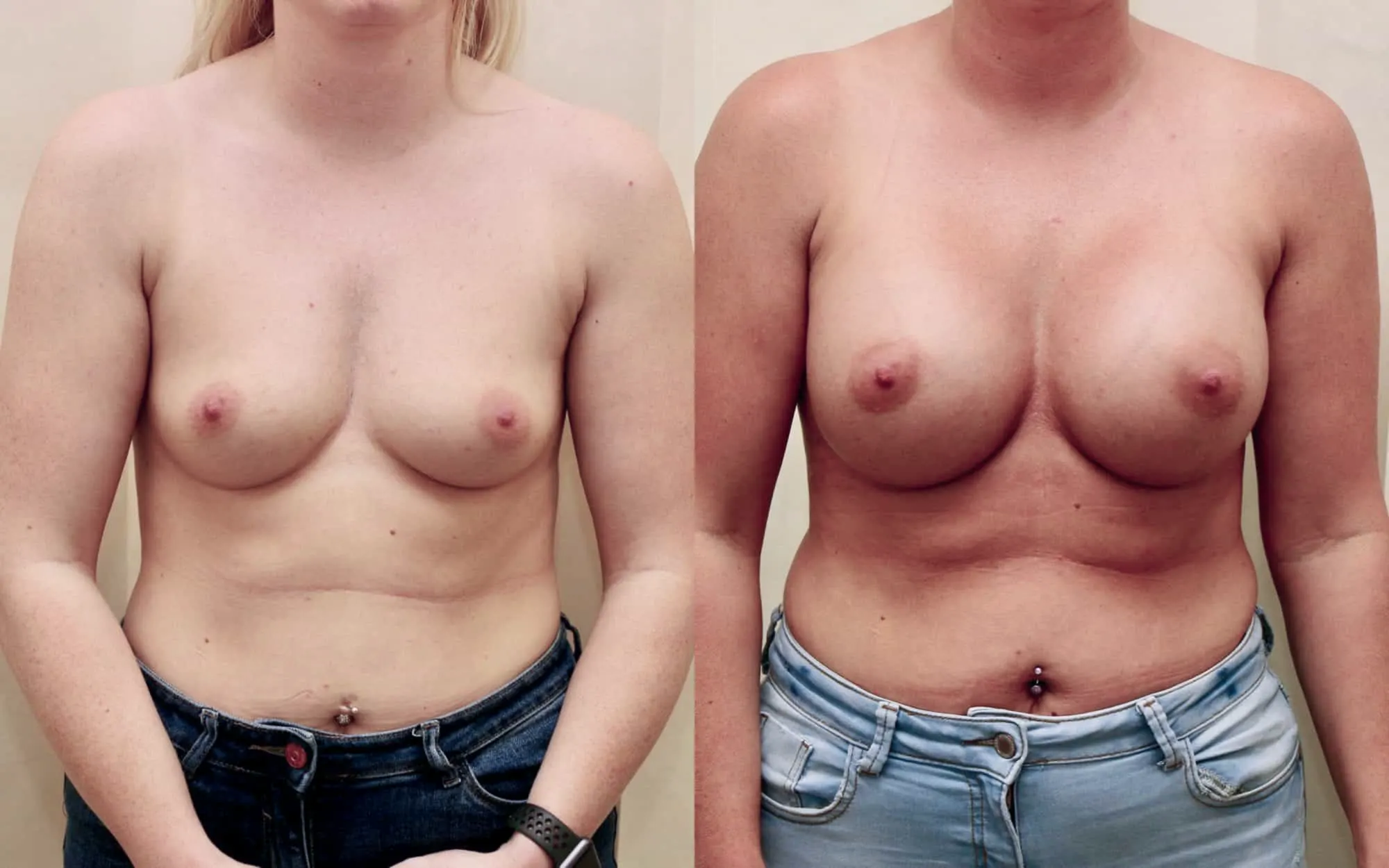 breast implants scotland