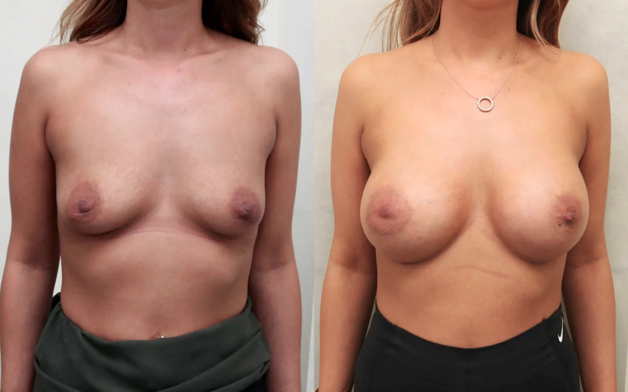 breast implants scotland