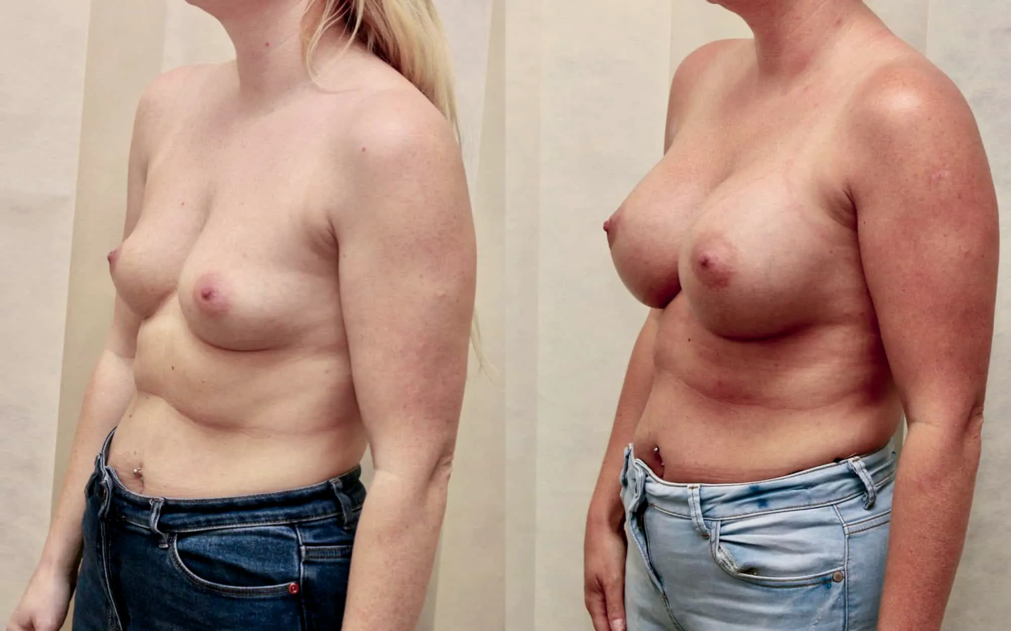 breast implants scotland