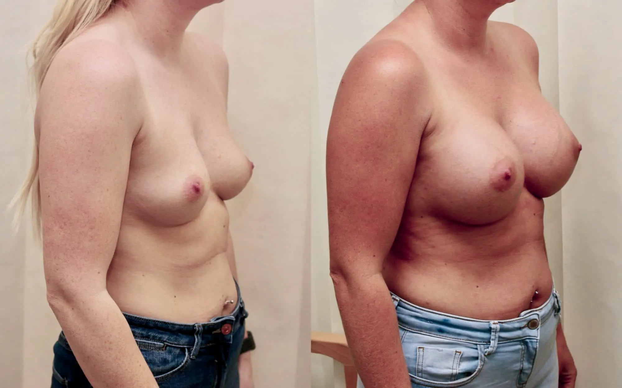 breast implants scotland