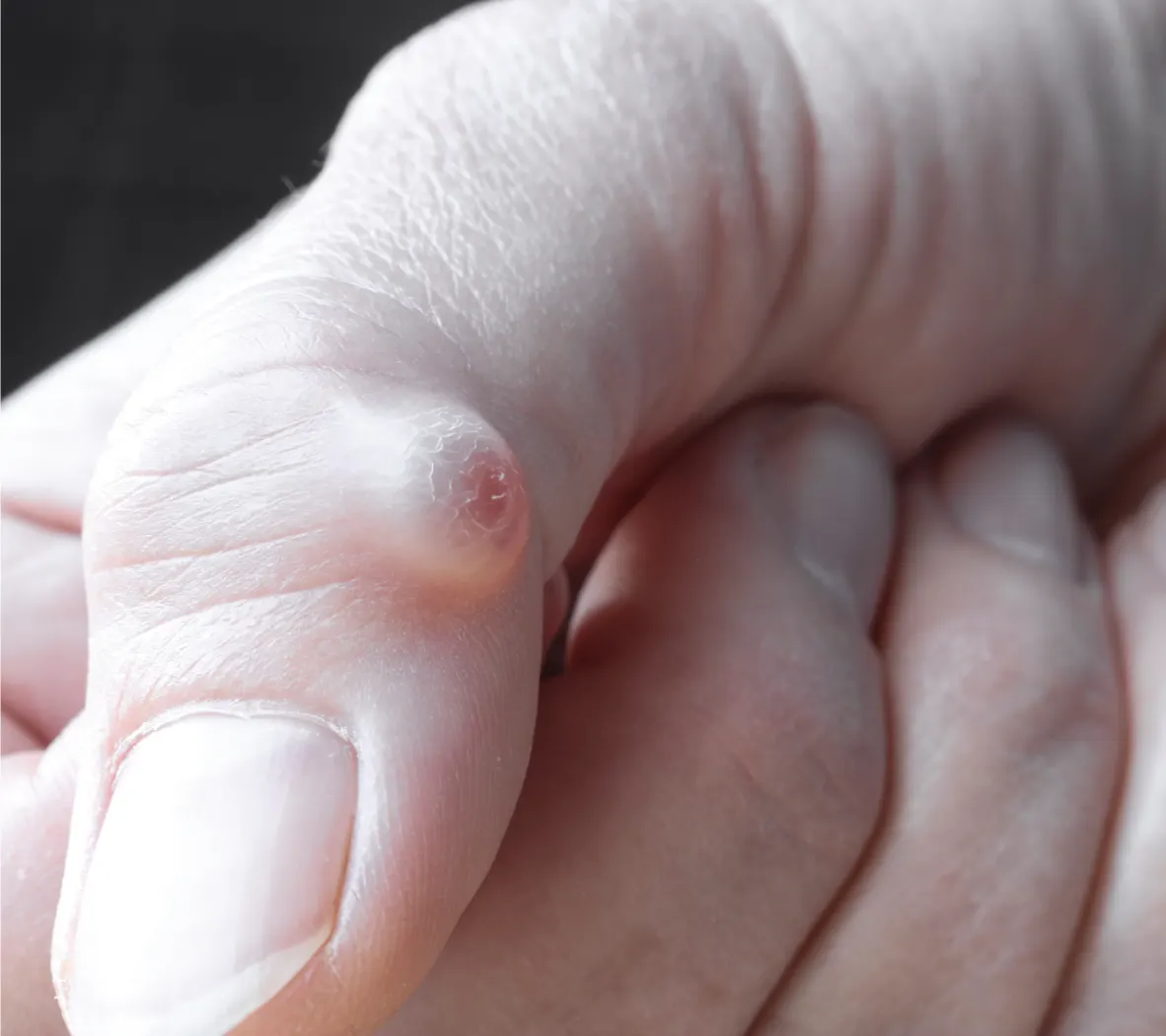 ganglion cyst treatment edinburgh