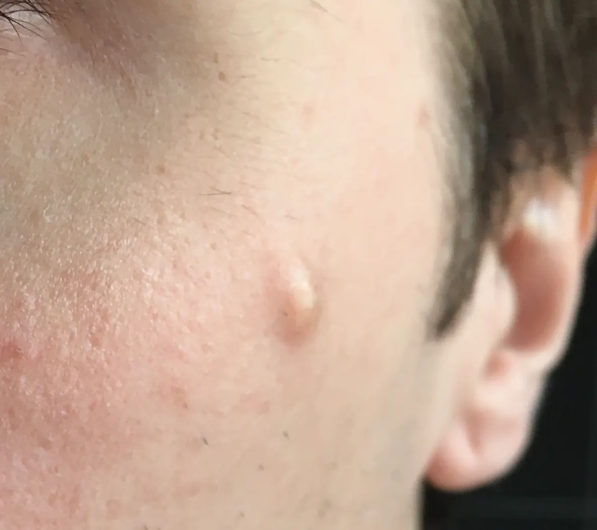 sebaceous cyst removal edinburgh