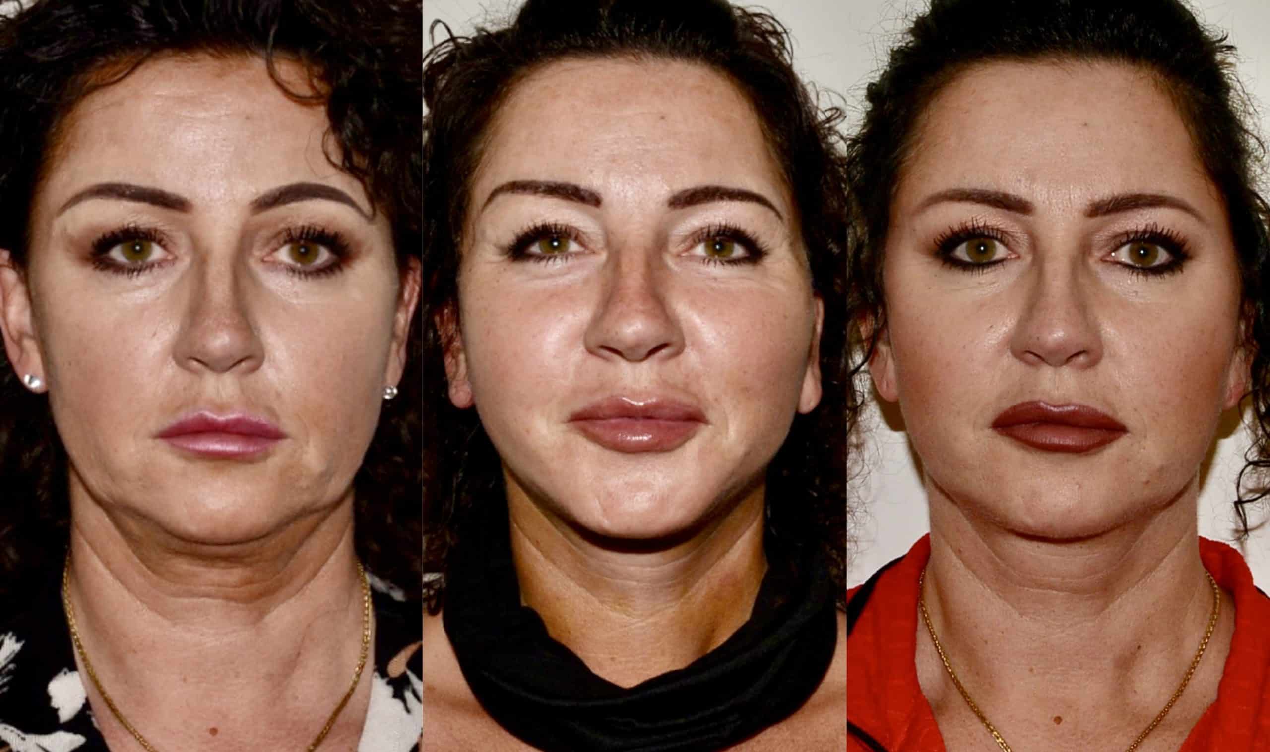 lower face neck lift