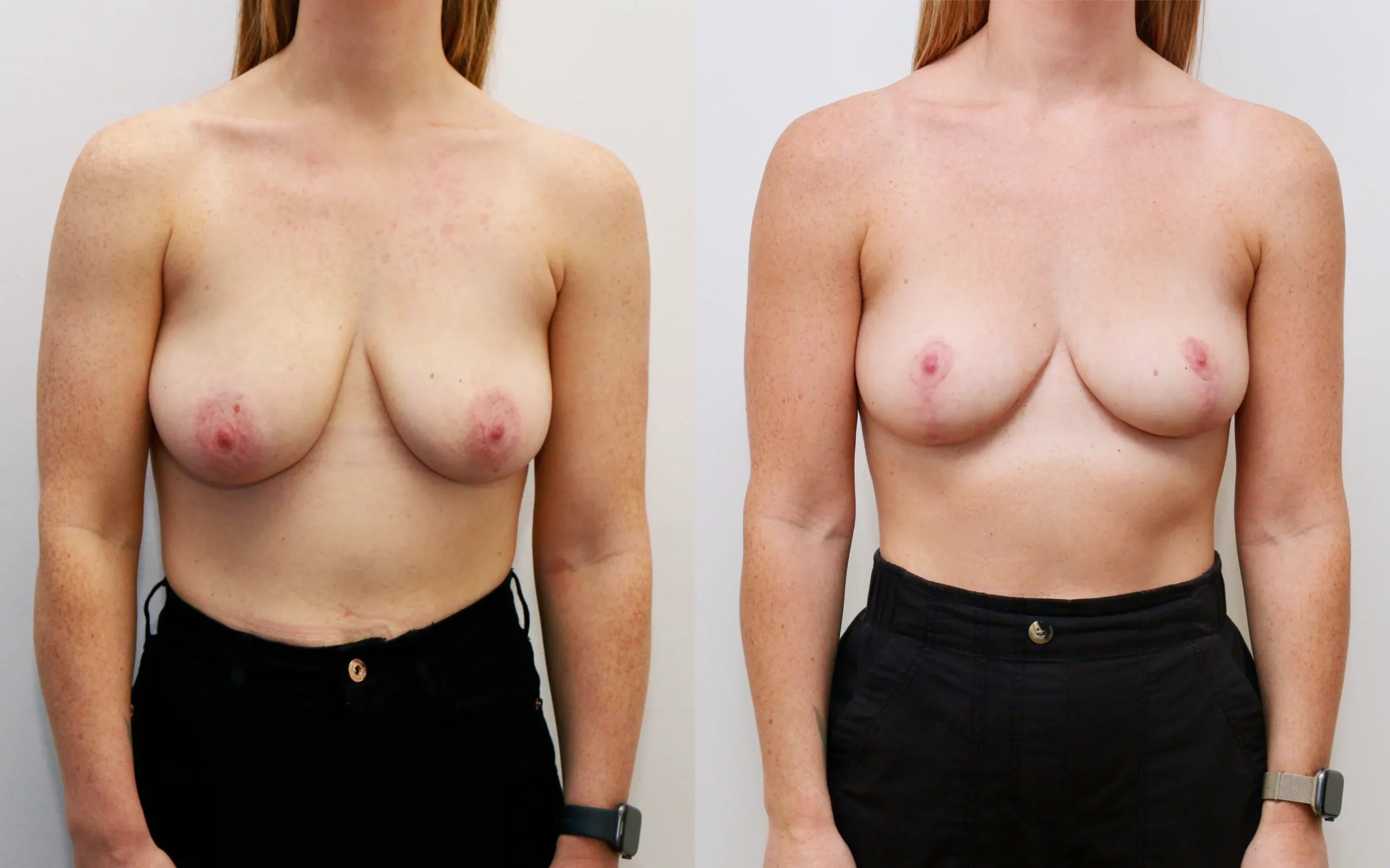 breast uplift