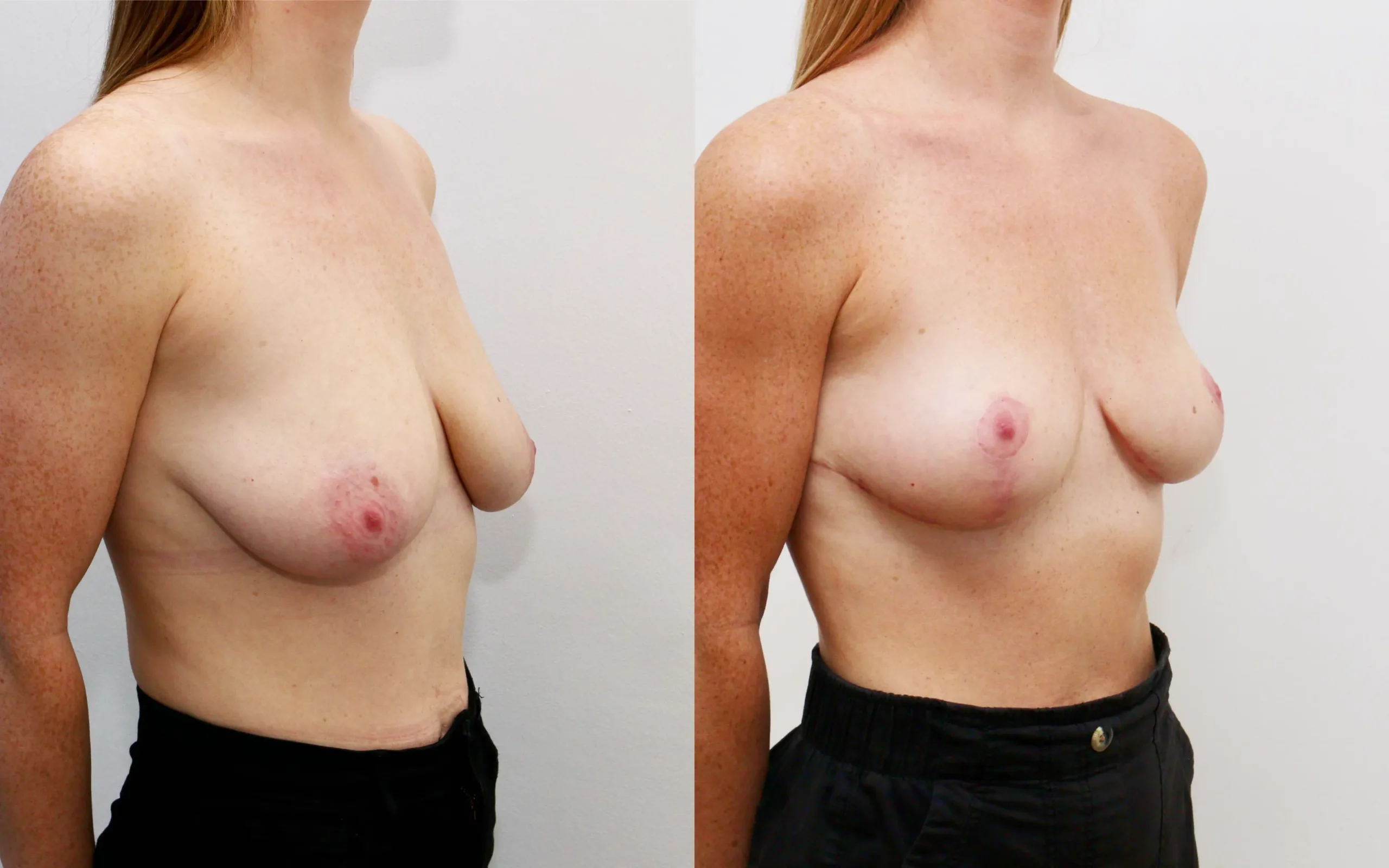 breast uplift