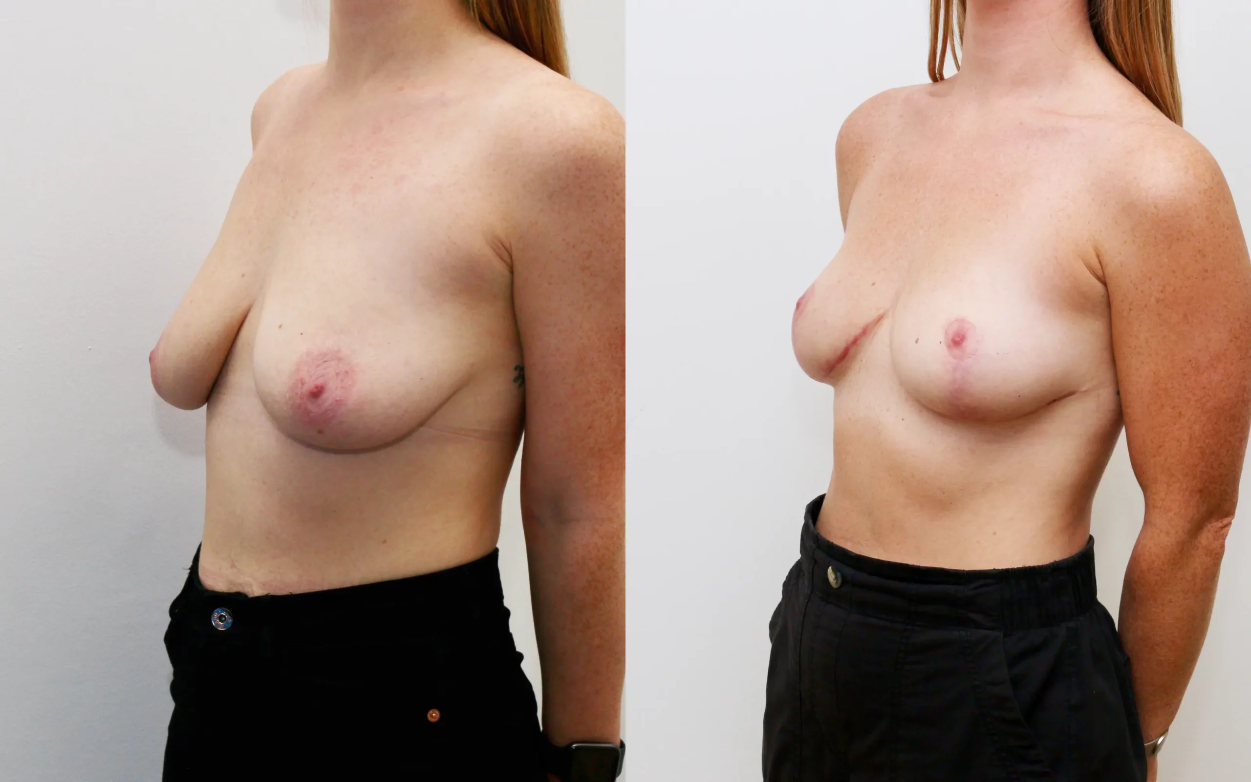 breast uplift