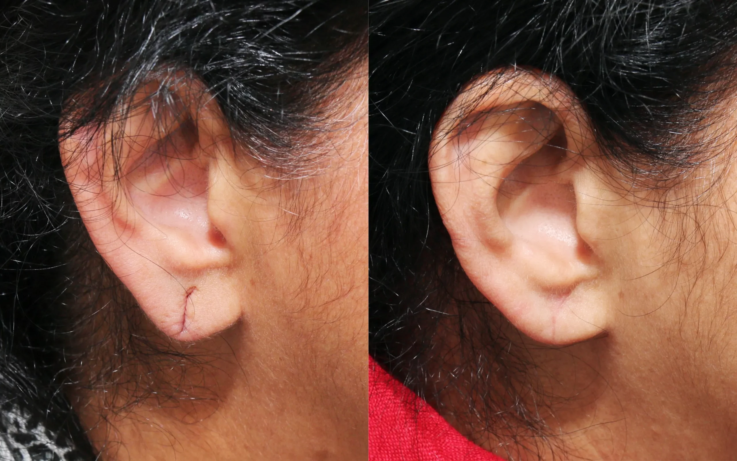 earlobe repair Edinburgh