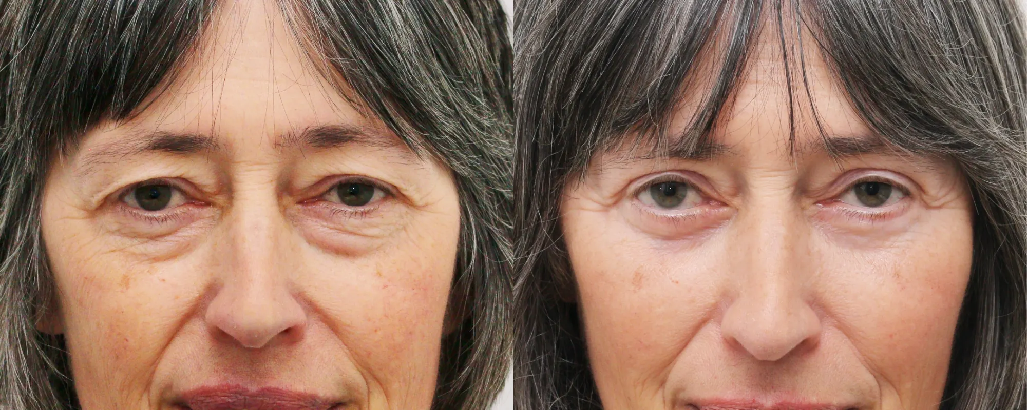 upper and lower eyelids