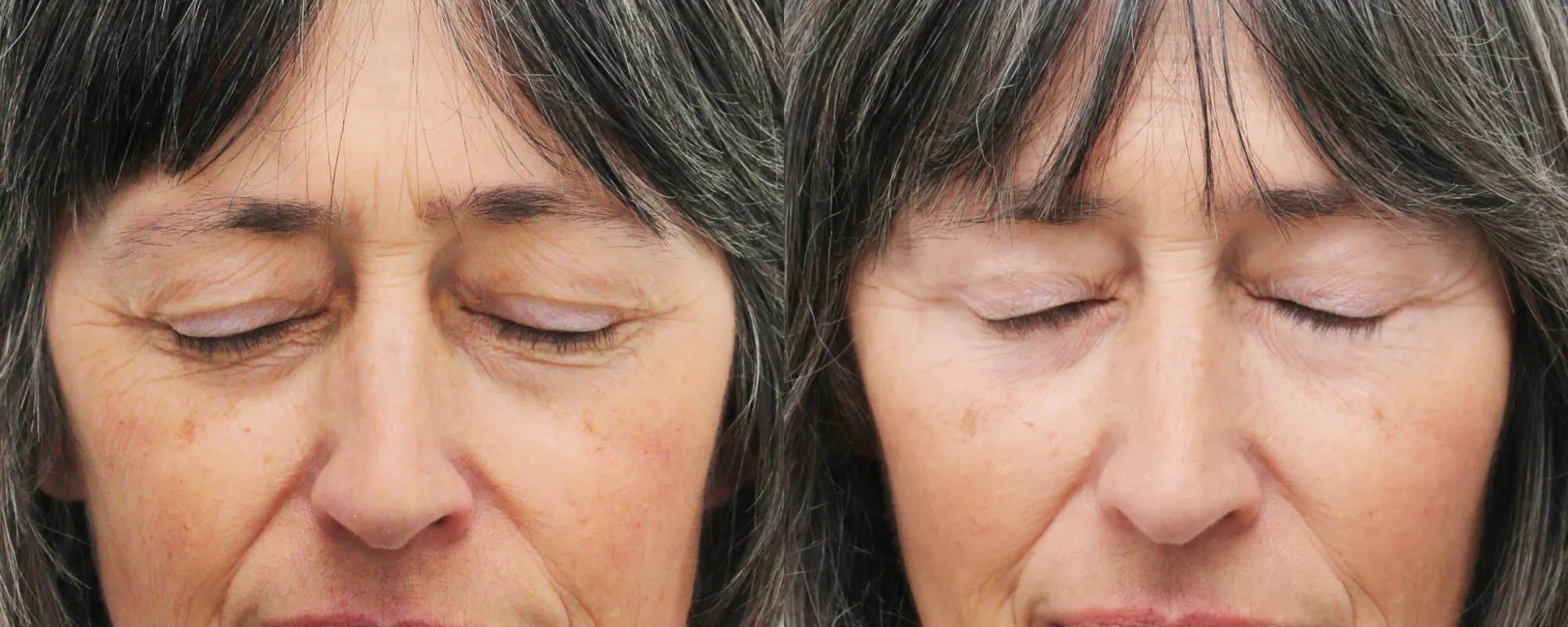 upper and lower eyelids