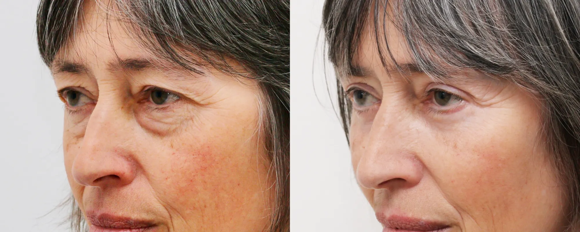 upper and lower eyelids