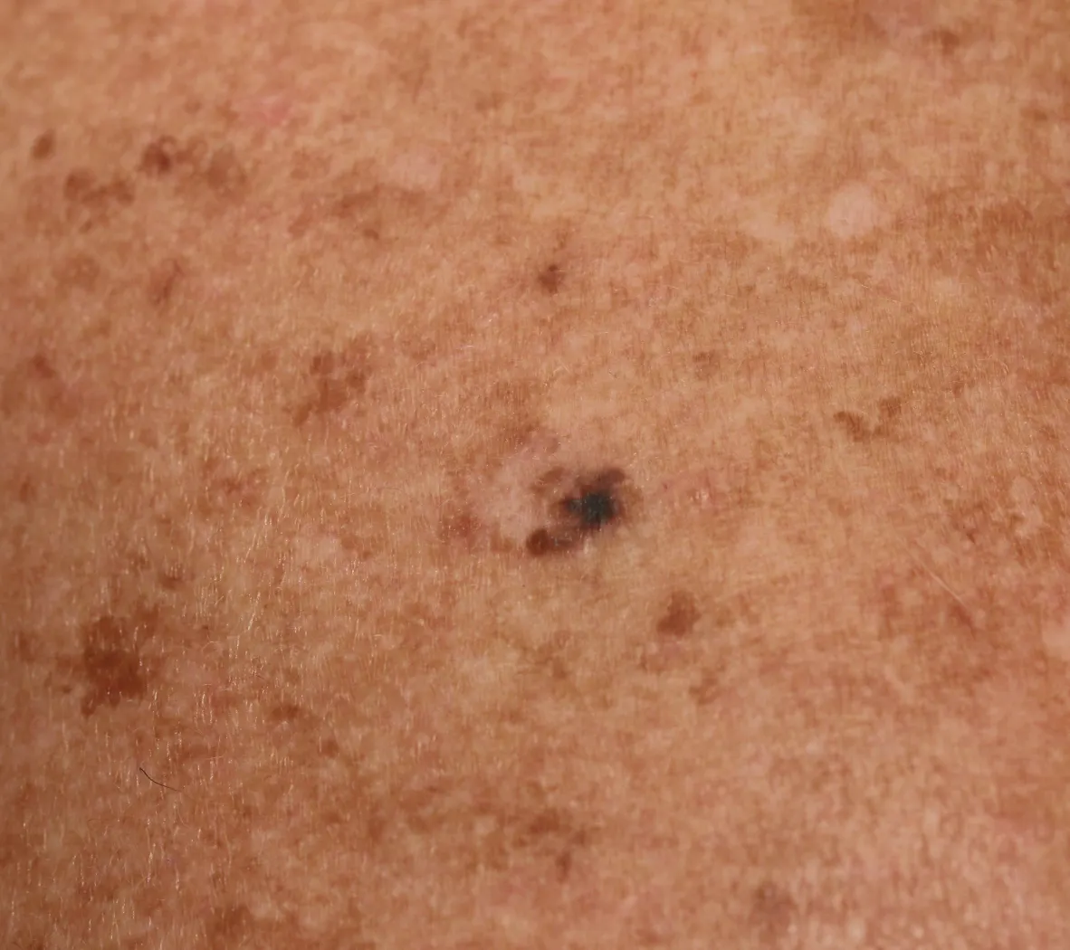 melanoma removal edinburgh