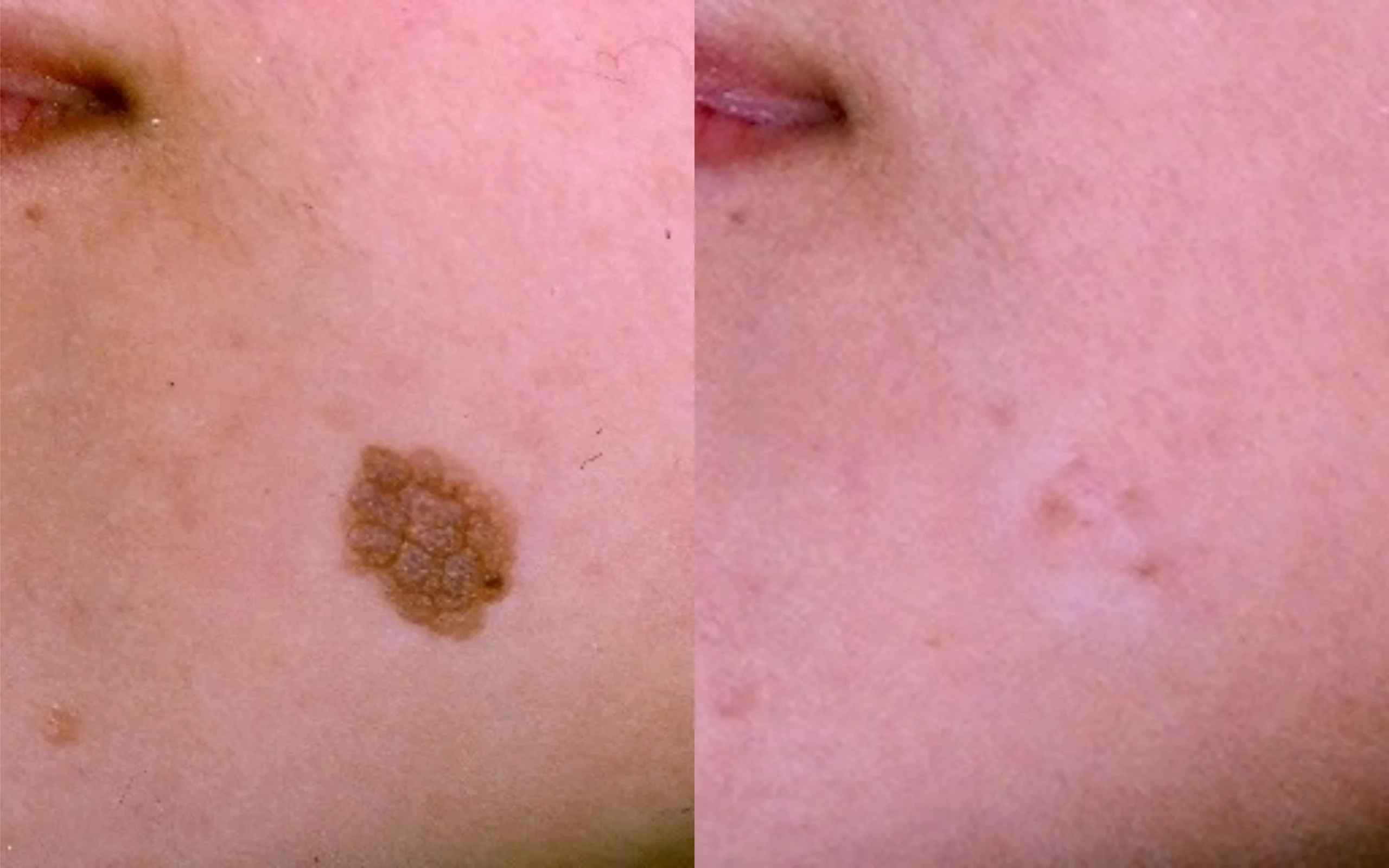 Cheek keratosis - shave excision