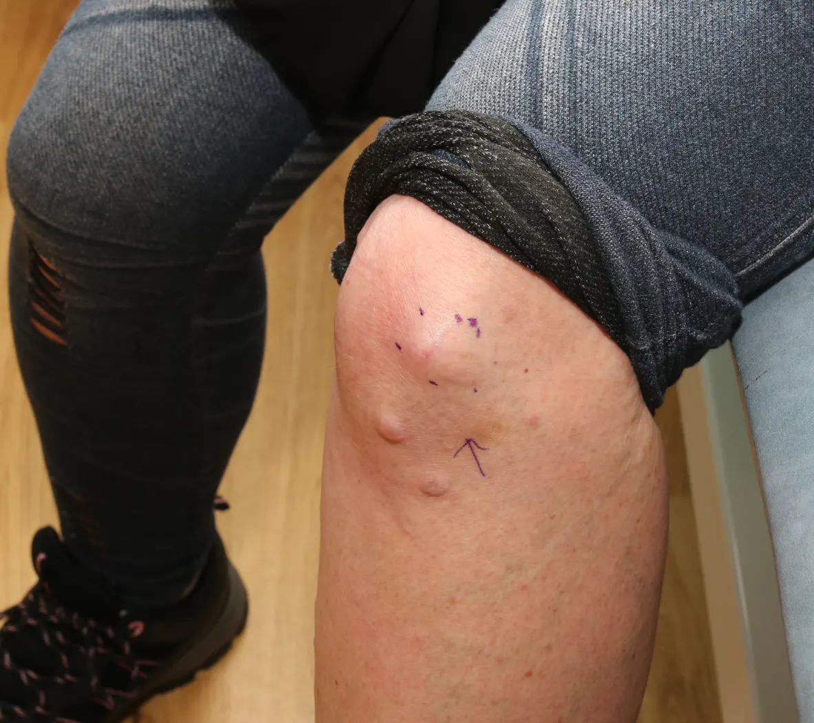 private sebaceous cyst removal edinburgh