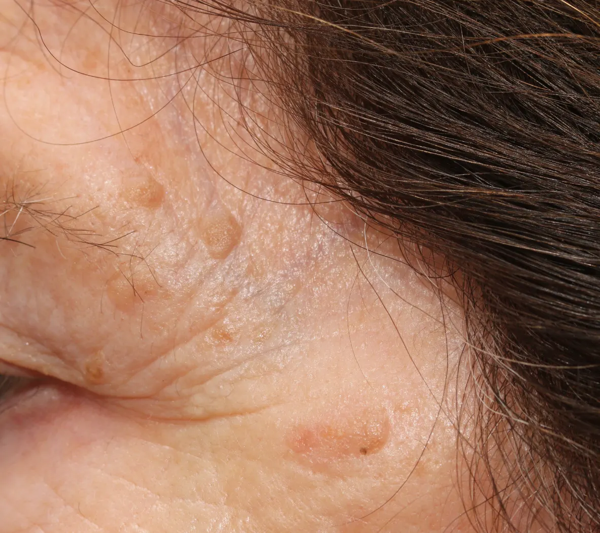 keratoses removal edinburgh