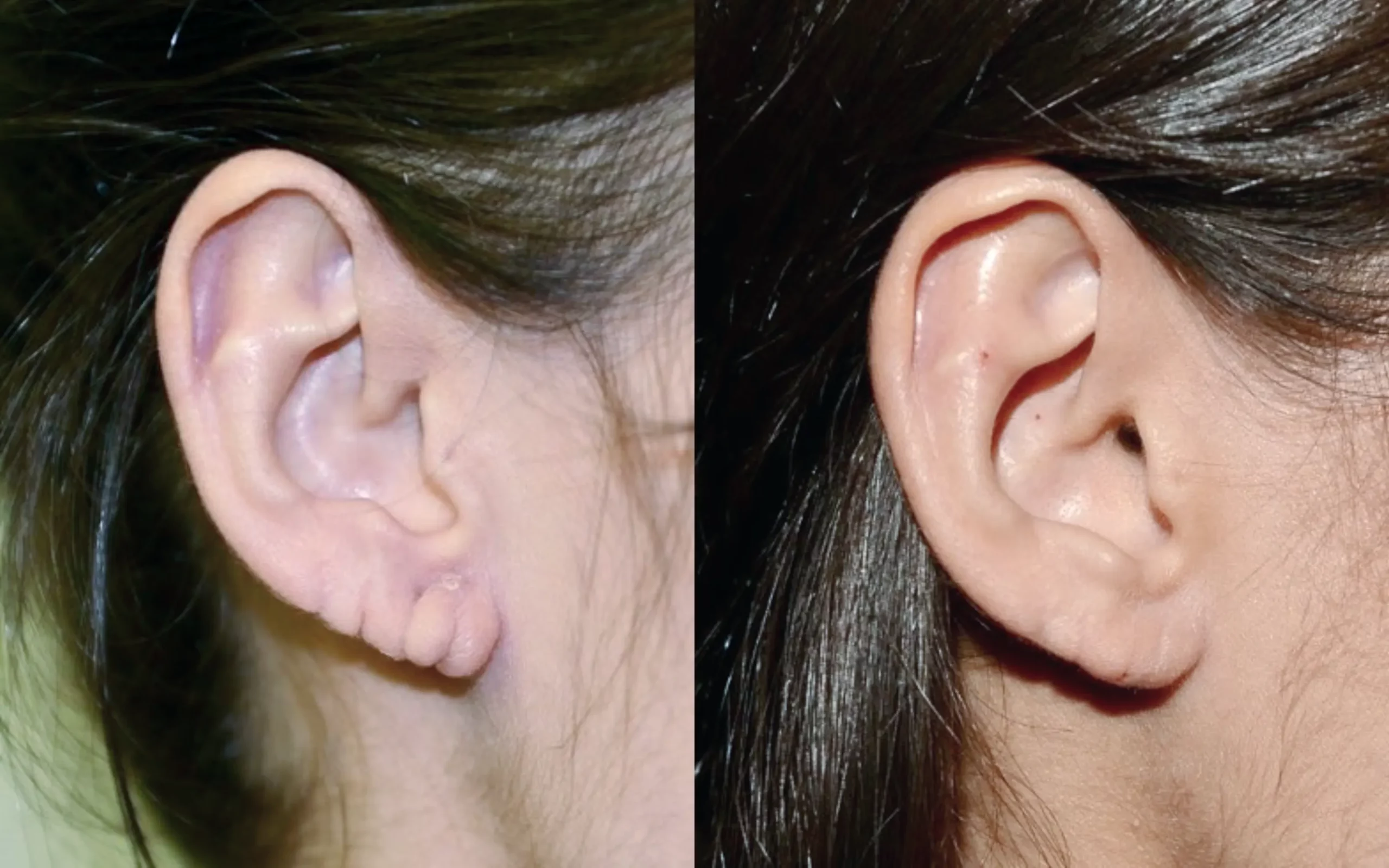 multiple split earlobe repair
