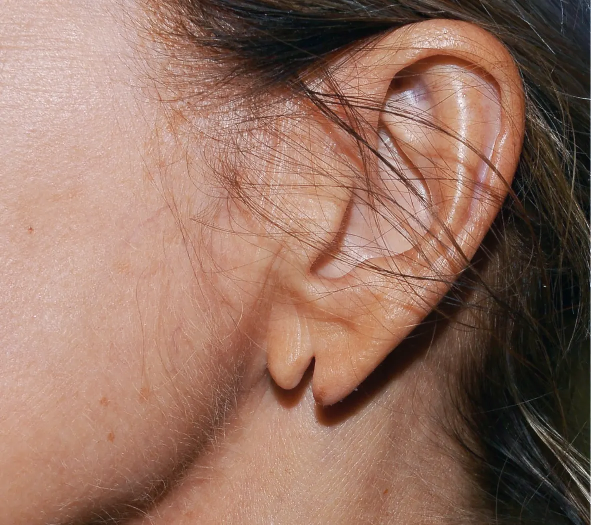 split earlobe surgery edinburgh