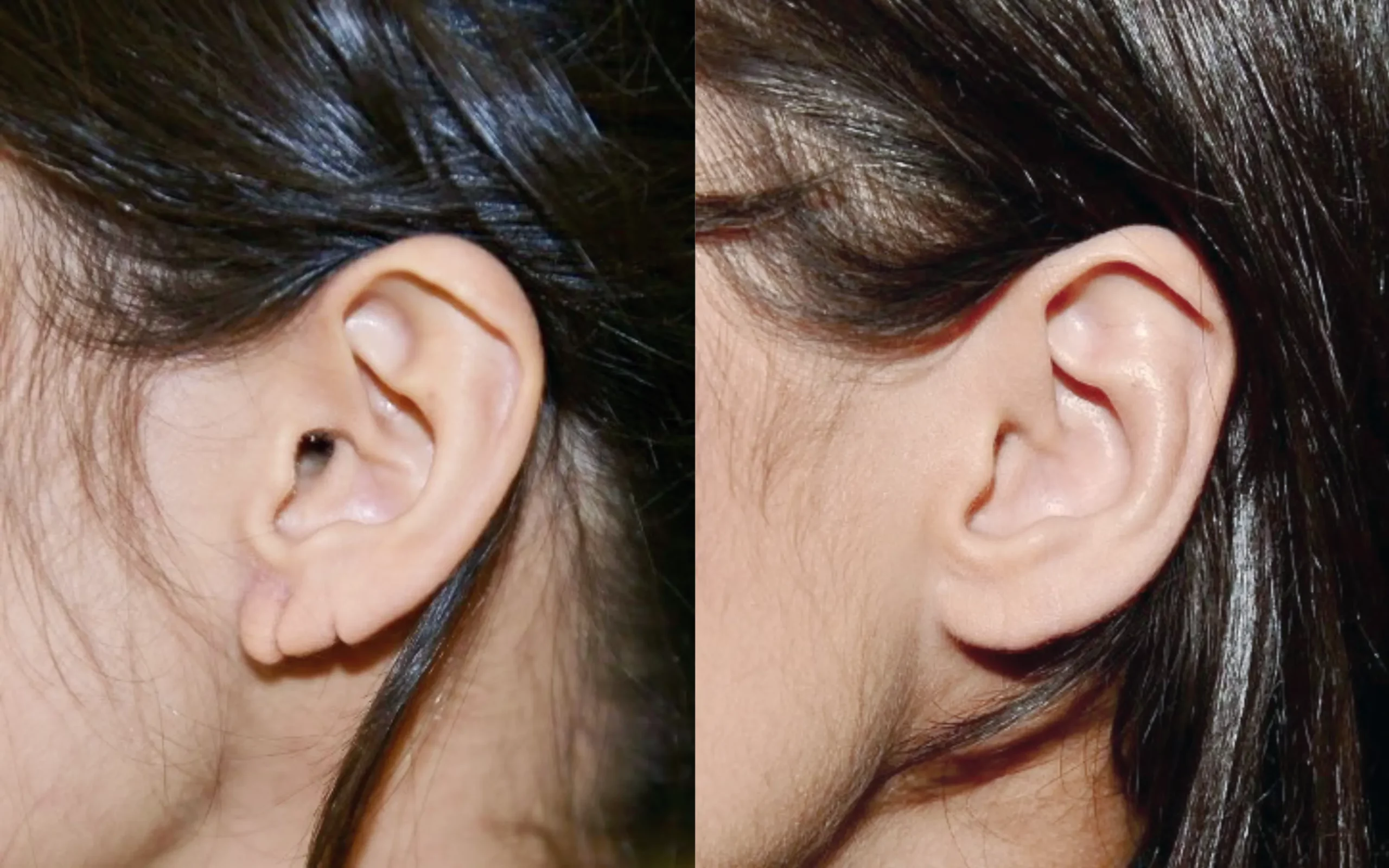 split earlobe repair